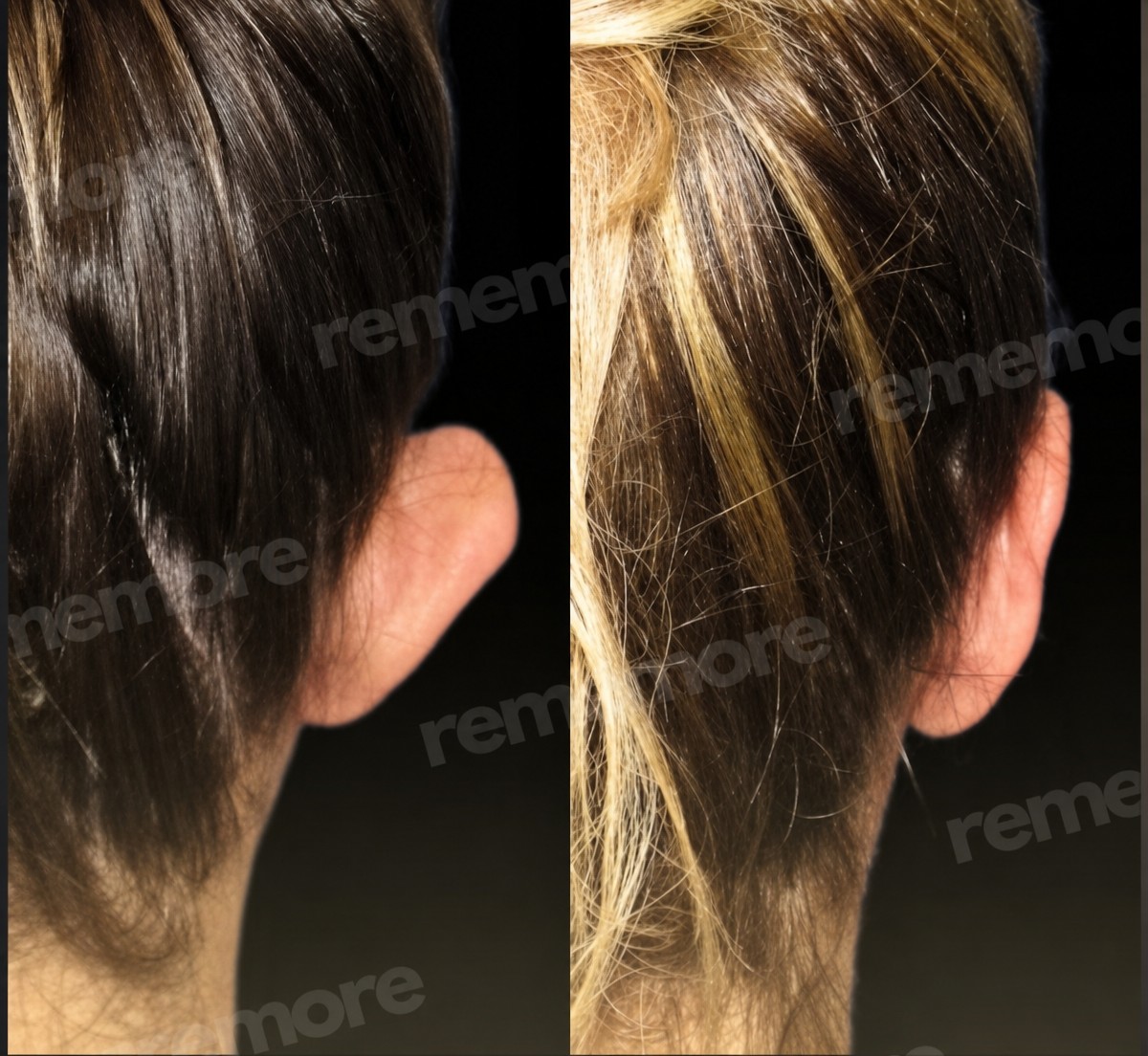 Before and after otoplasty results at Memorial Şişli Hospital, ear reshaping surgery outcome
