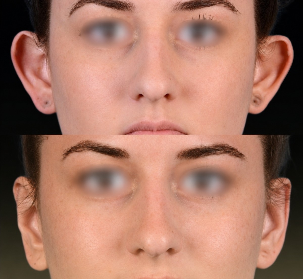 Before and after otoplasty results at Memorial Şişli Hospital, improved ear shape and symmetry