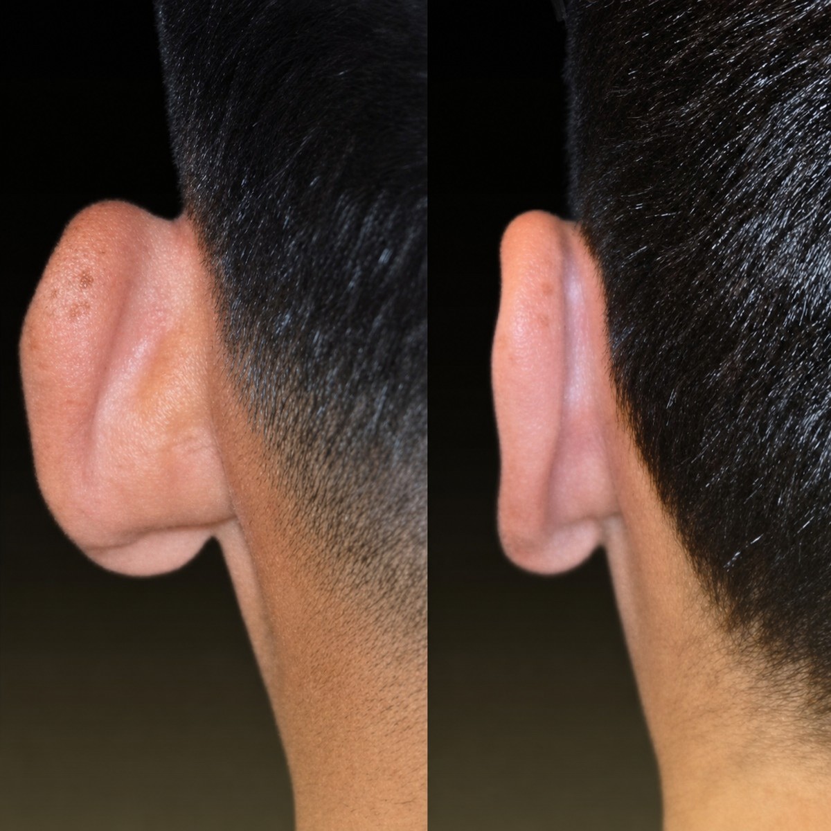 Otoplasty before and after results at Memorial Şişli Hospital, improved ear shape and position