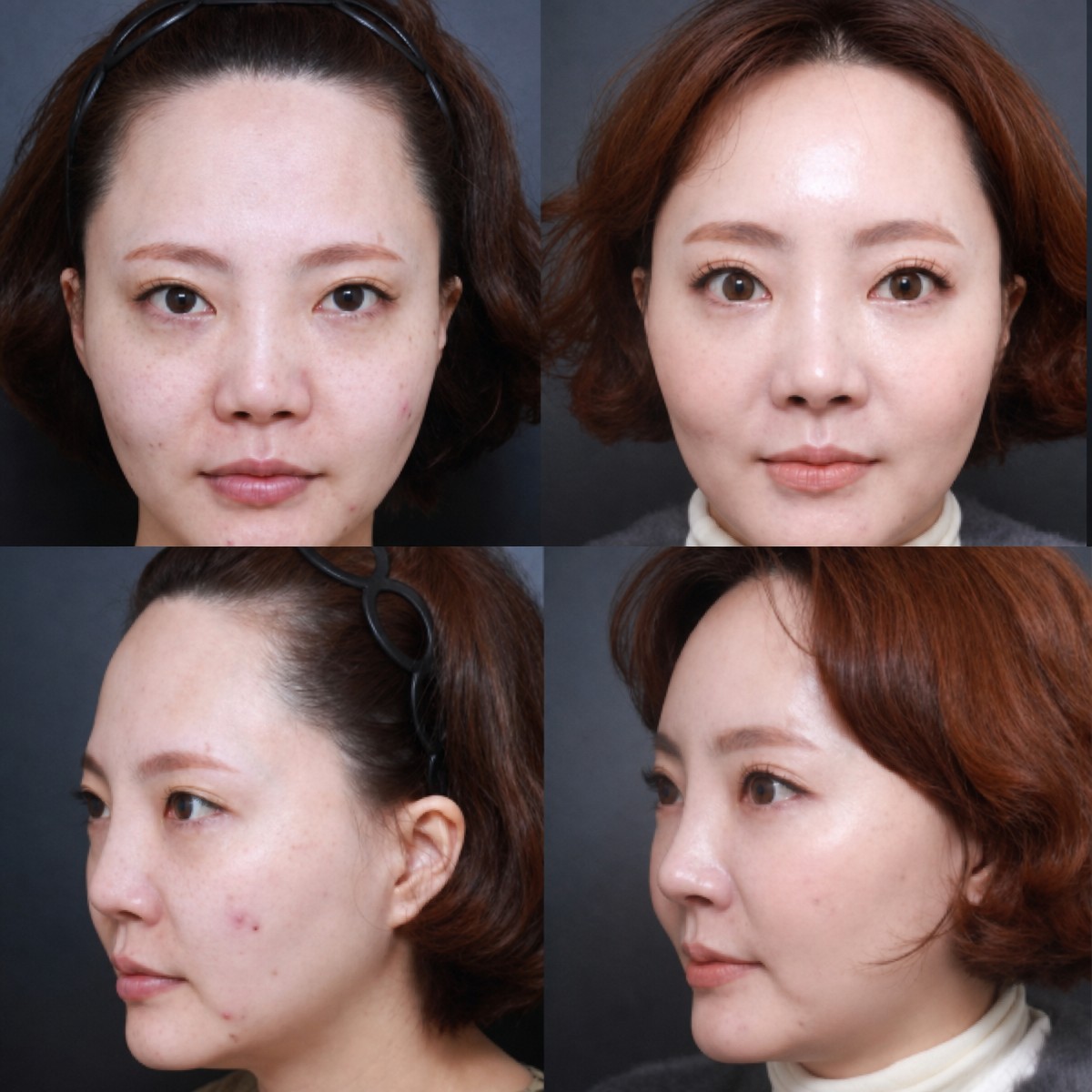 Before and after brow lift results at VG Plastic Surgery, visible forehead and eye area lift