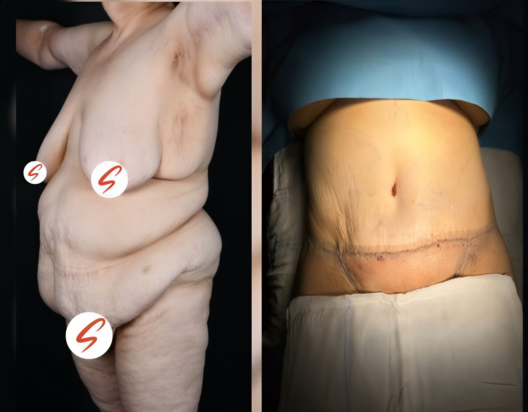 Resultados de abdominoplastia y liposucción antes y después en Dr Selcuk Aytac Clinic, mejor contorno