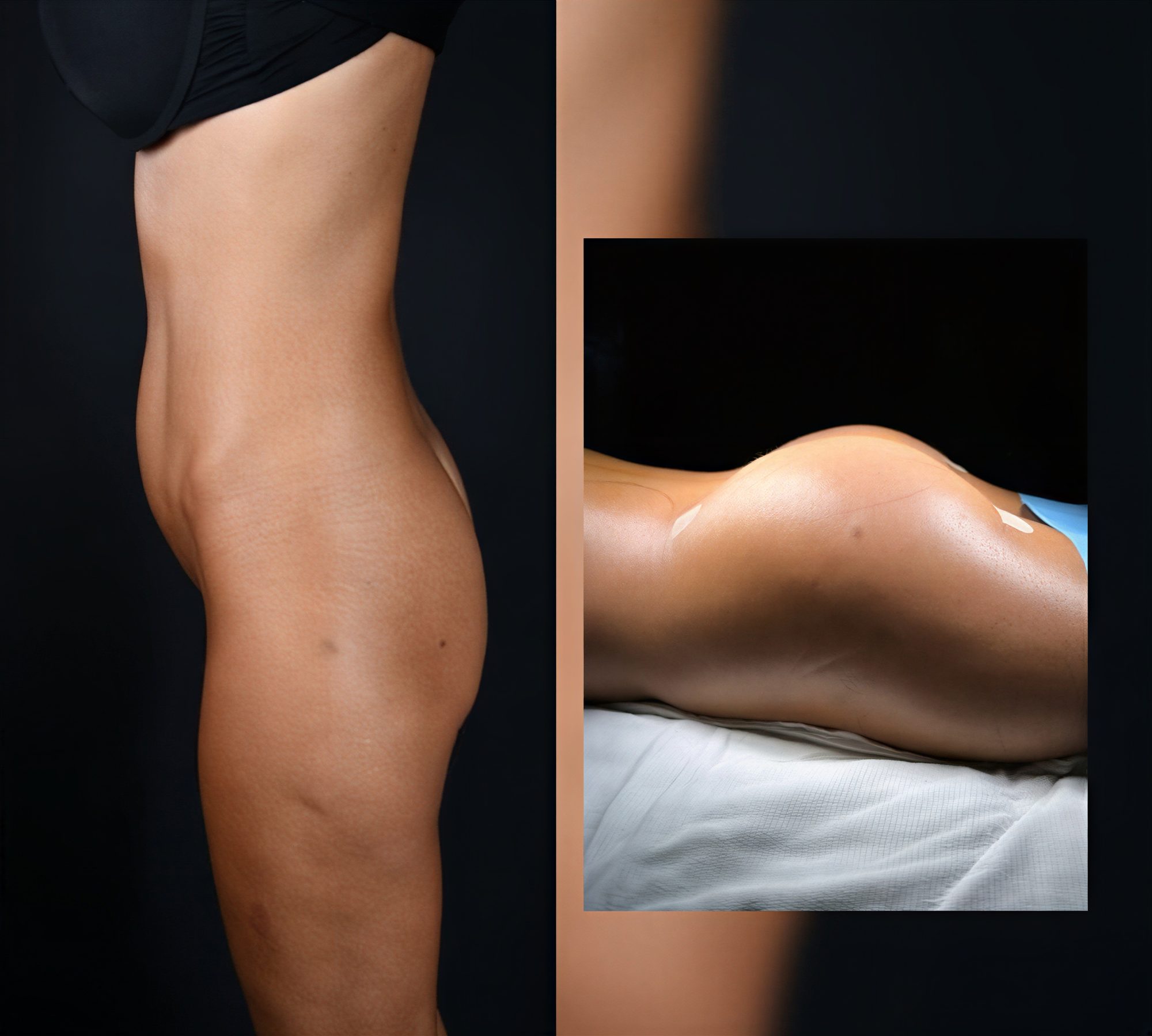 Resultados antes y después de Brazilian Butt Lift en Dr Selcuk Aytac Clinic, glúteos realzados