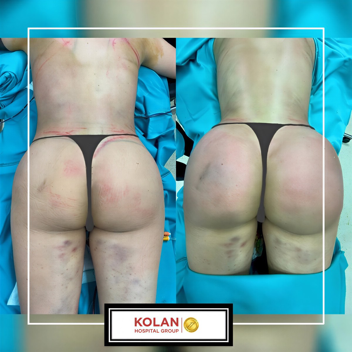Resultados antes y después de mommy makeover en Estophia Hospital – contorno corporal mejorado