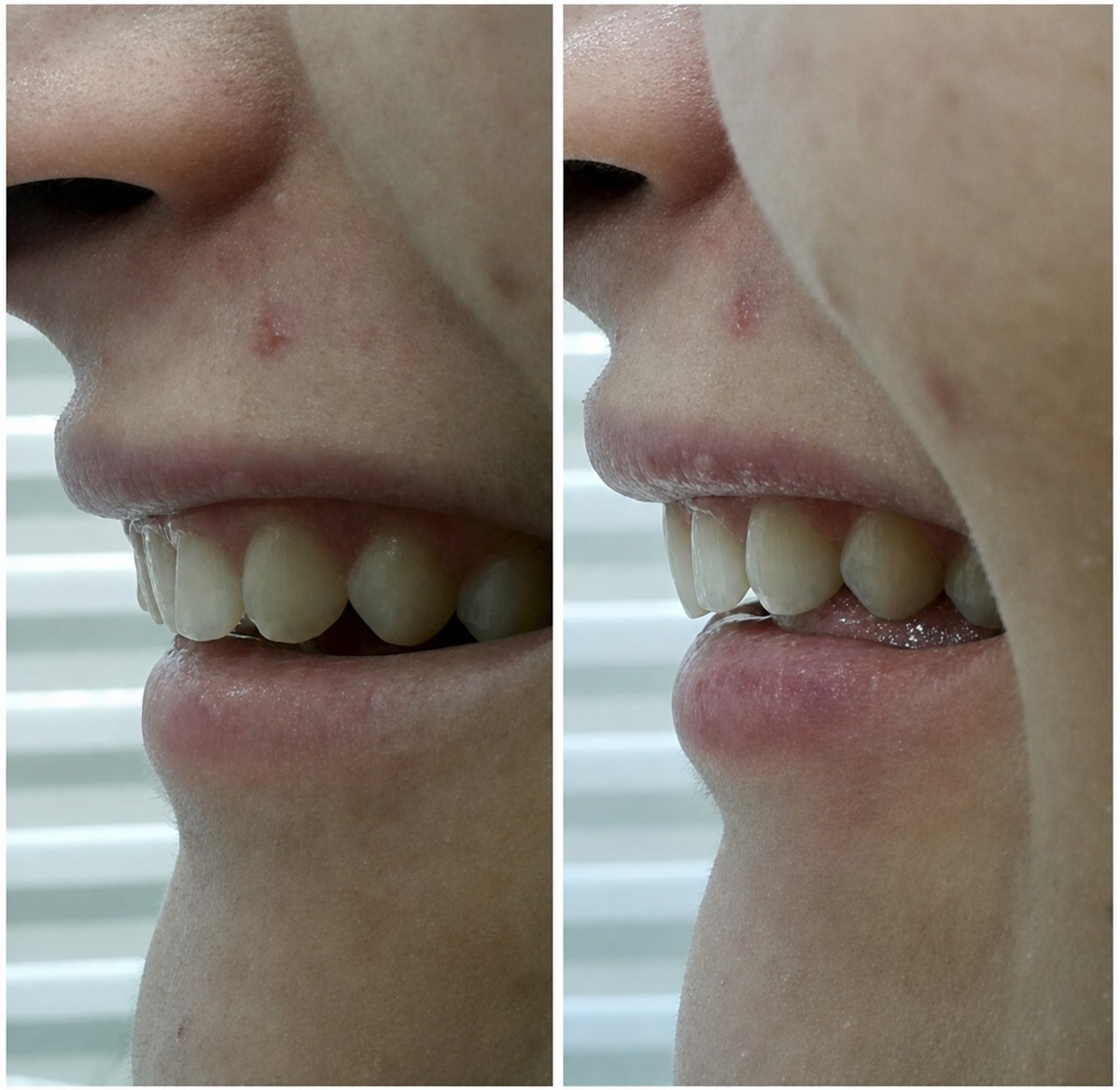 Resultados de Lumineers antes y después en WestDent Clinic: sonrisa y alineación mejoradas