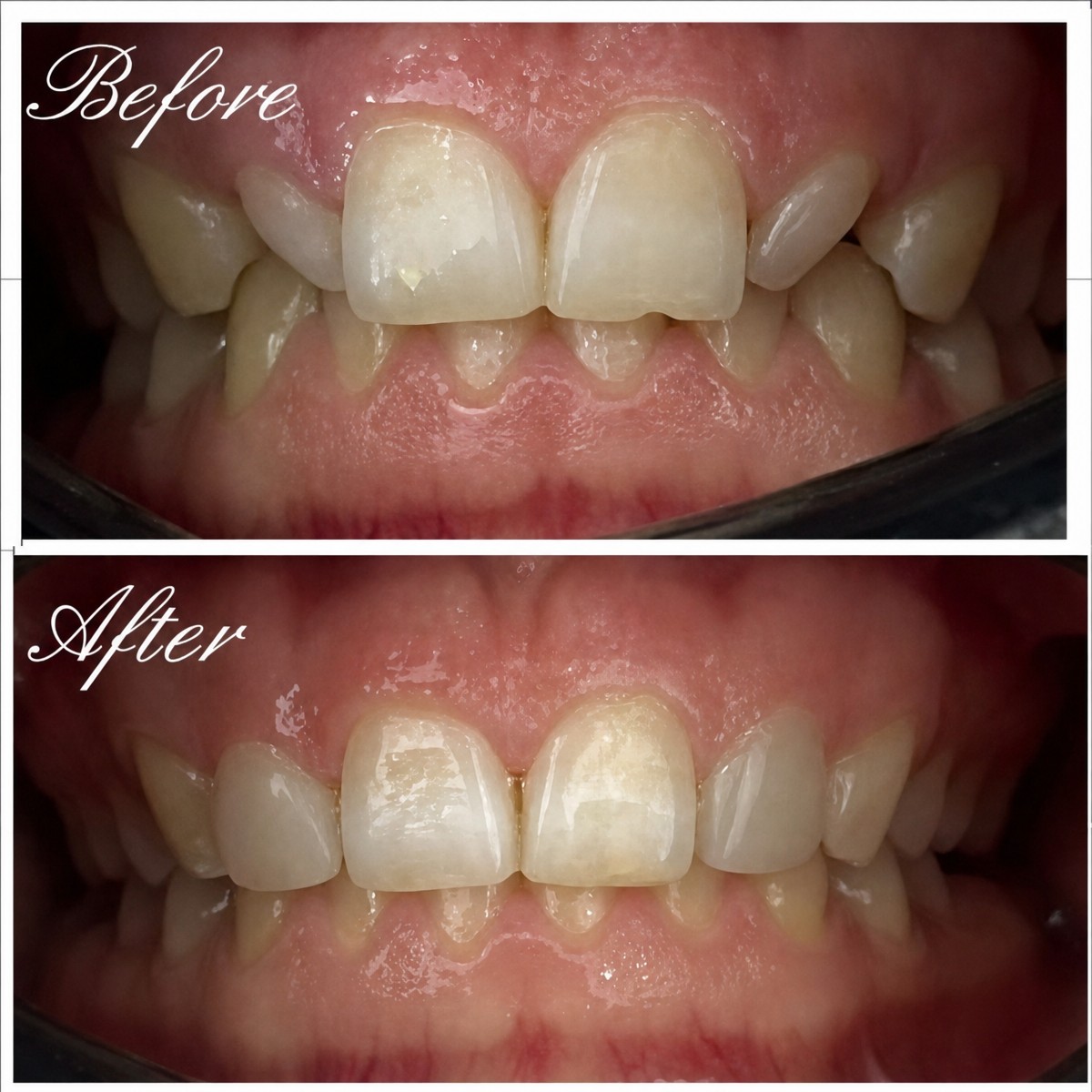 Before and after dental bonding results at Morsia Dental Clinic for improved front teeth