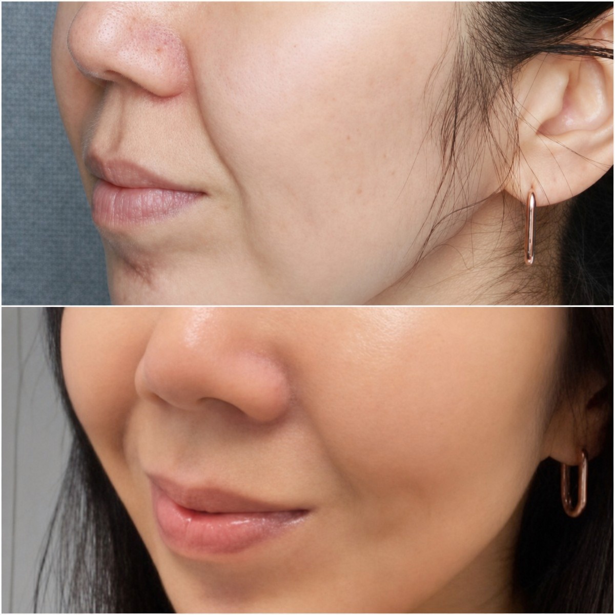 قبل وبعد علاج Skinbooster في Oracle Clinic Cheongdam، نتيجة بشرة وجه أكثر نعومة