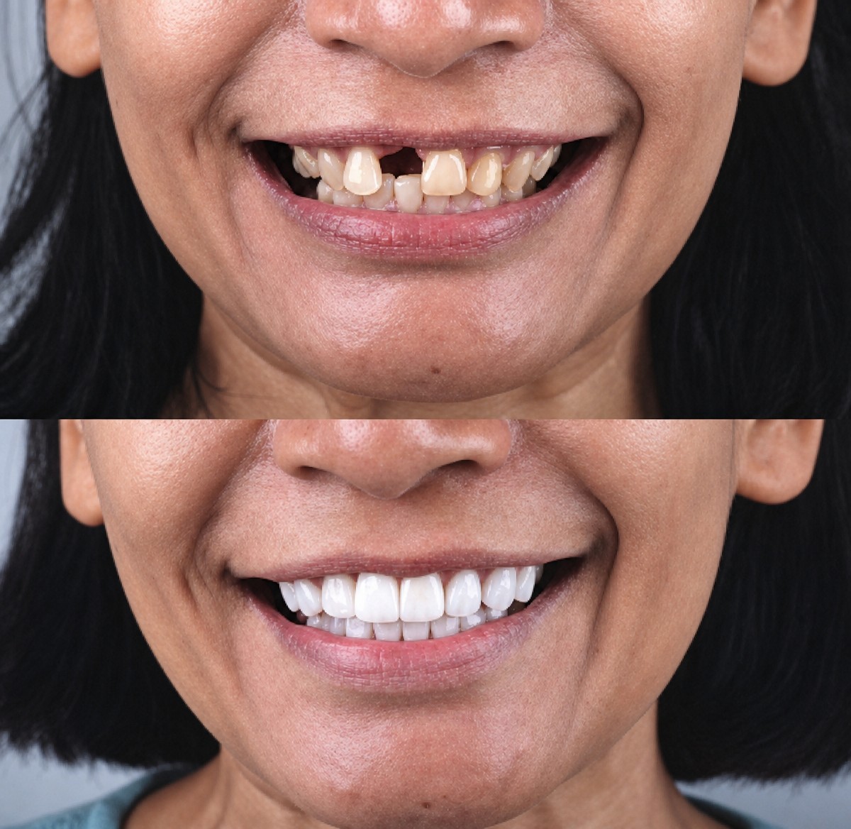 До и после установки виниров в About Tooth Dental Clinic – естественное преображение улыбки
