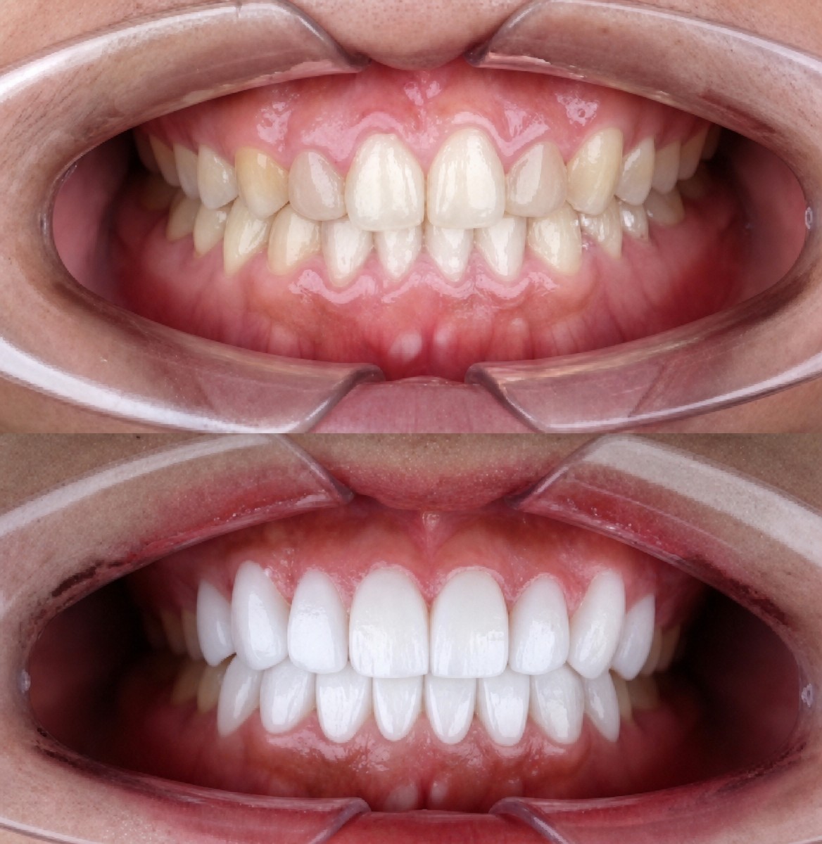 Resultados de carillas dentales antes y después en About Tooth Dental Clinic – sonrisa blanca