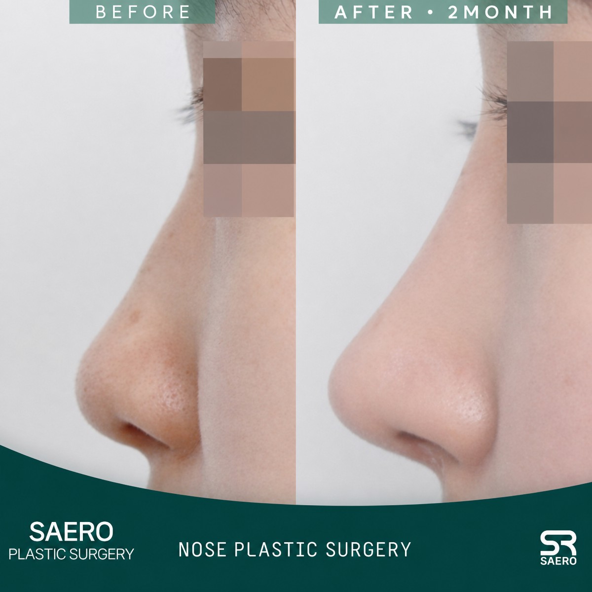 Before and after tip rhinoplasty results at SAERO Plastic Surgery, improved nose contour