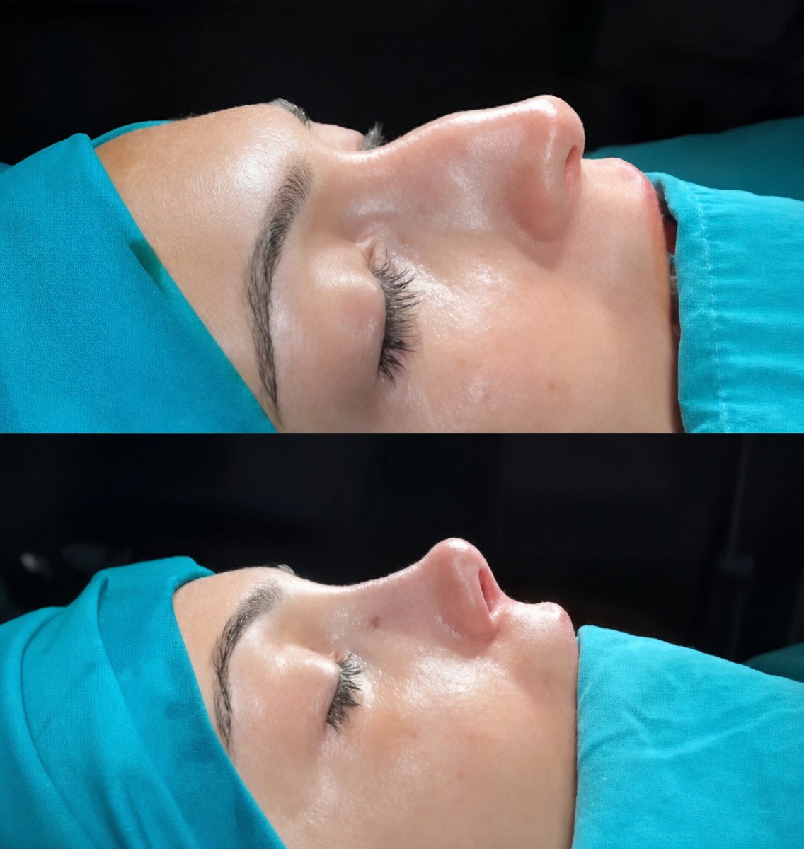 Before and after rhinoplasty result at Ento Surgical Medical Center, nose reshaping surgery