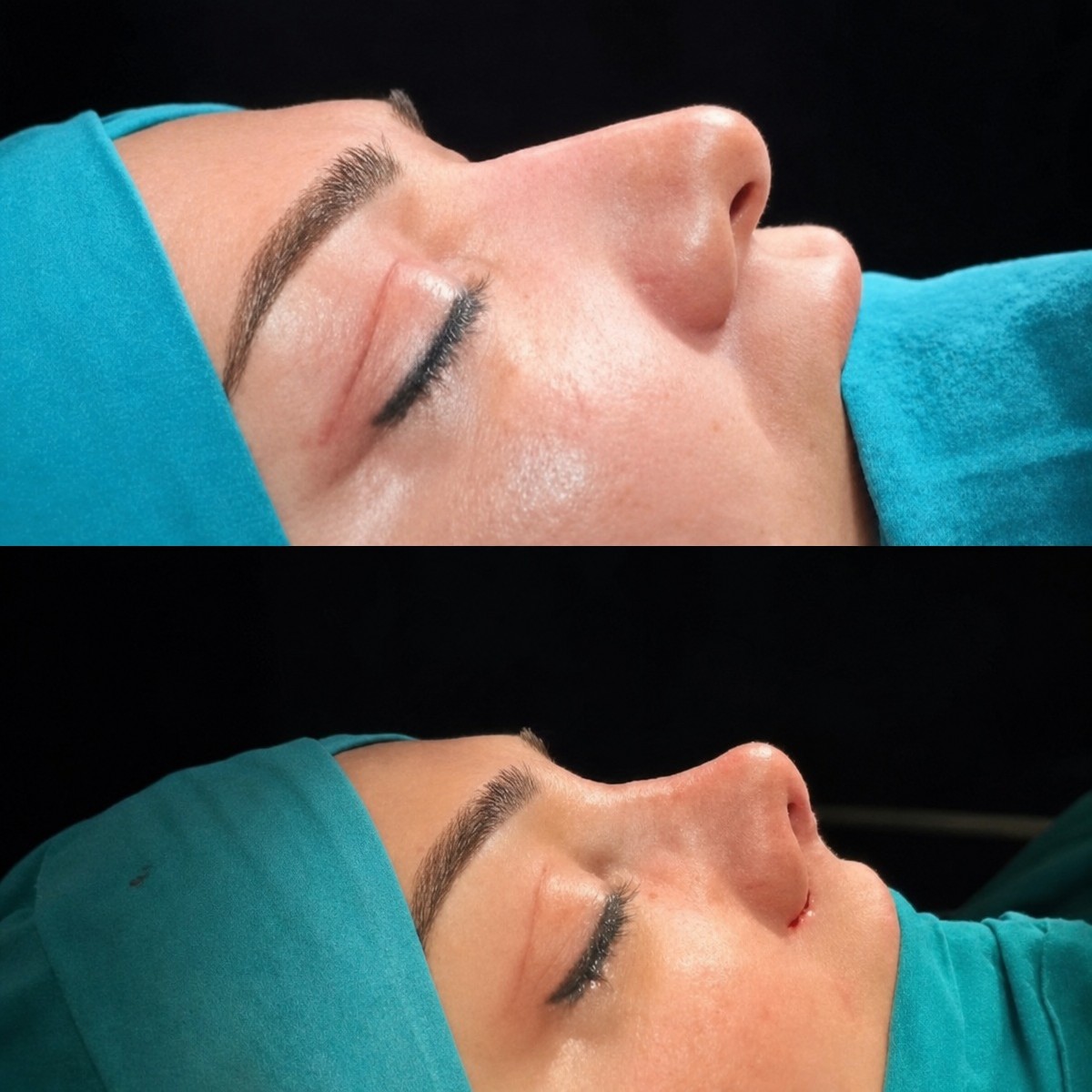 نتائج قبل وبعد عملية تجميل الأنف المغلقة في Ento Surgical Medical Center، إعادة تشكيل الأنف