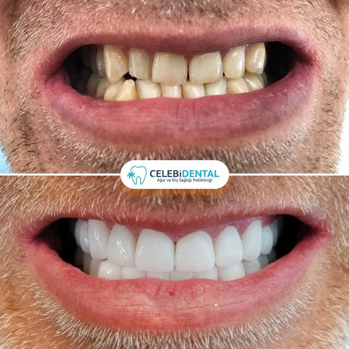 Resultados antes y después de coronas dentales en Celebi Dental Clinics, sonrisa mejorada