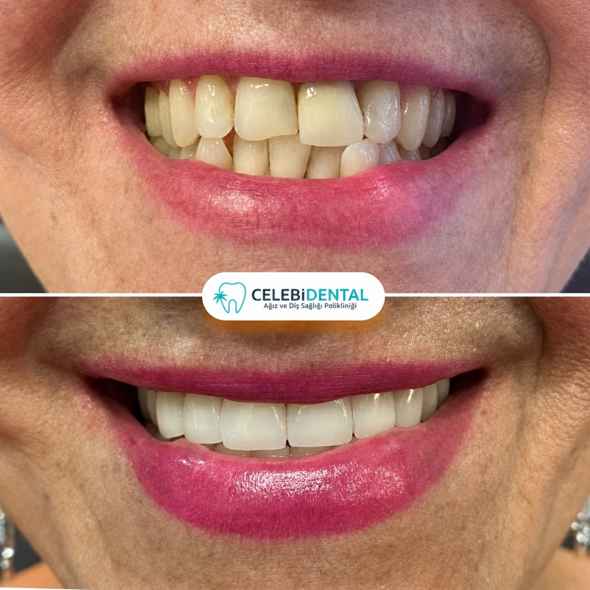 Before and after zirconia crown results at Celebi Dental Clinics – improved smile aesthetics