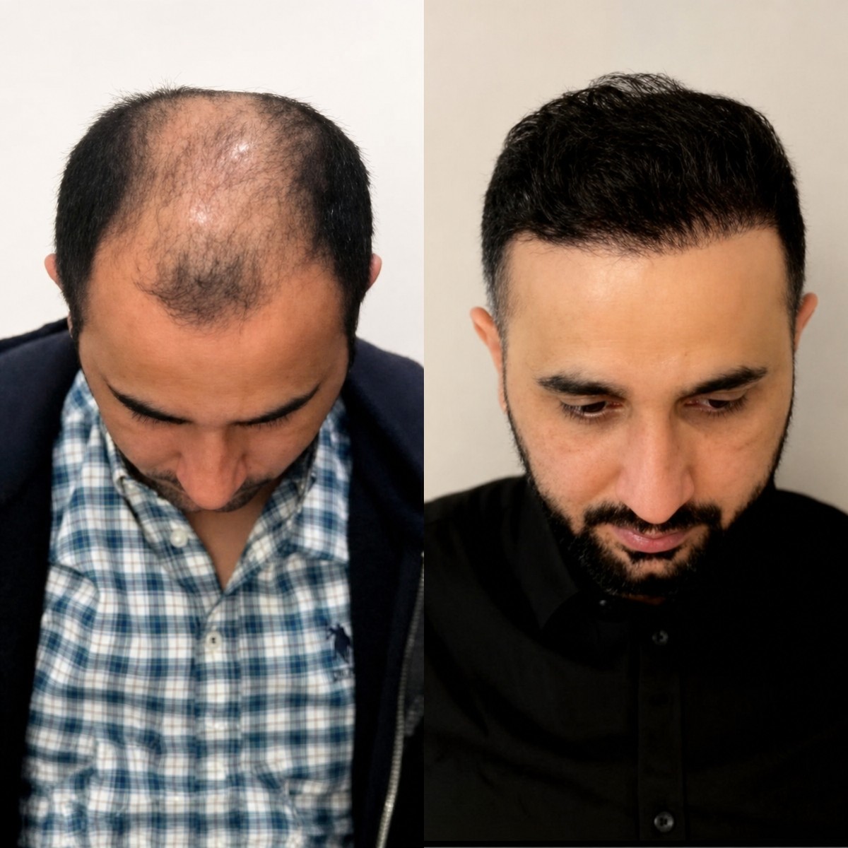 Résultats avant et après greffe de cheveux chez Dr. MED – ligne capillaire restaurée