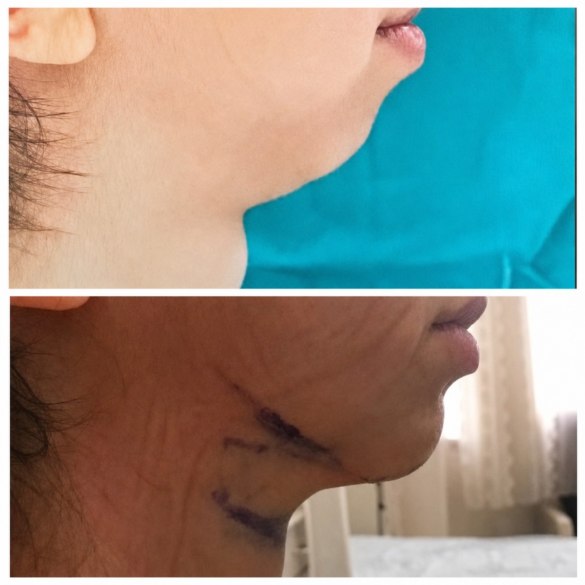 Resultados antes y después de implante de mentón en Prof. Furkan Karabekmez's Aesthetic Surgery Clinic