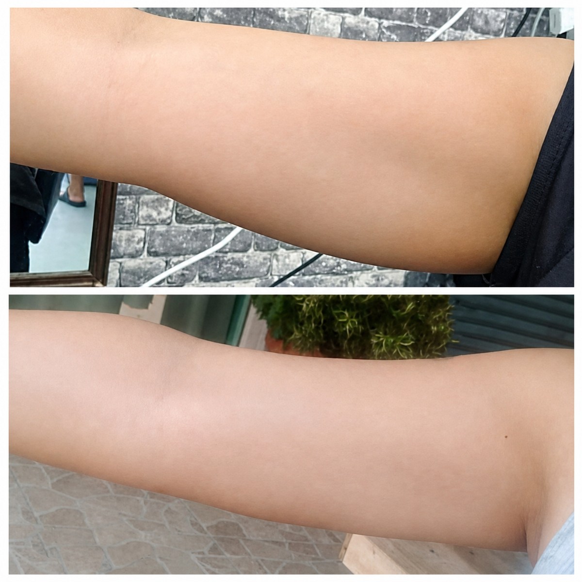 Resultados de liposucción de brazos antes y después en Tonliew Clinic, contorno mejorado