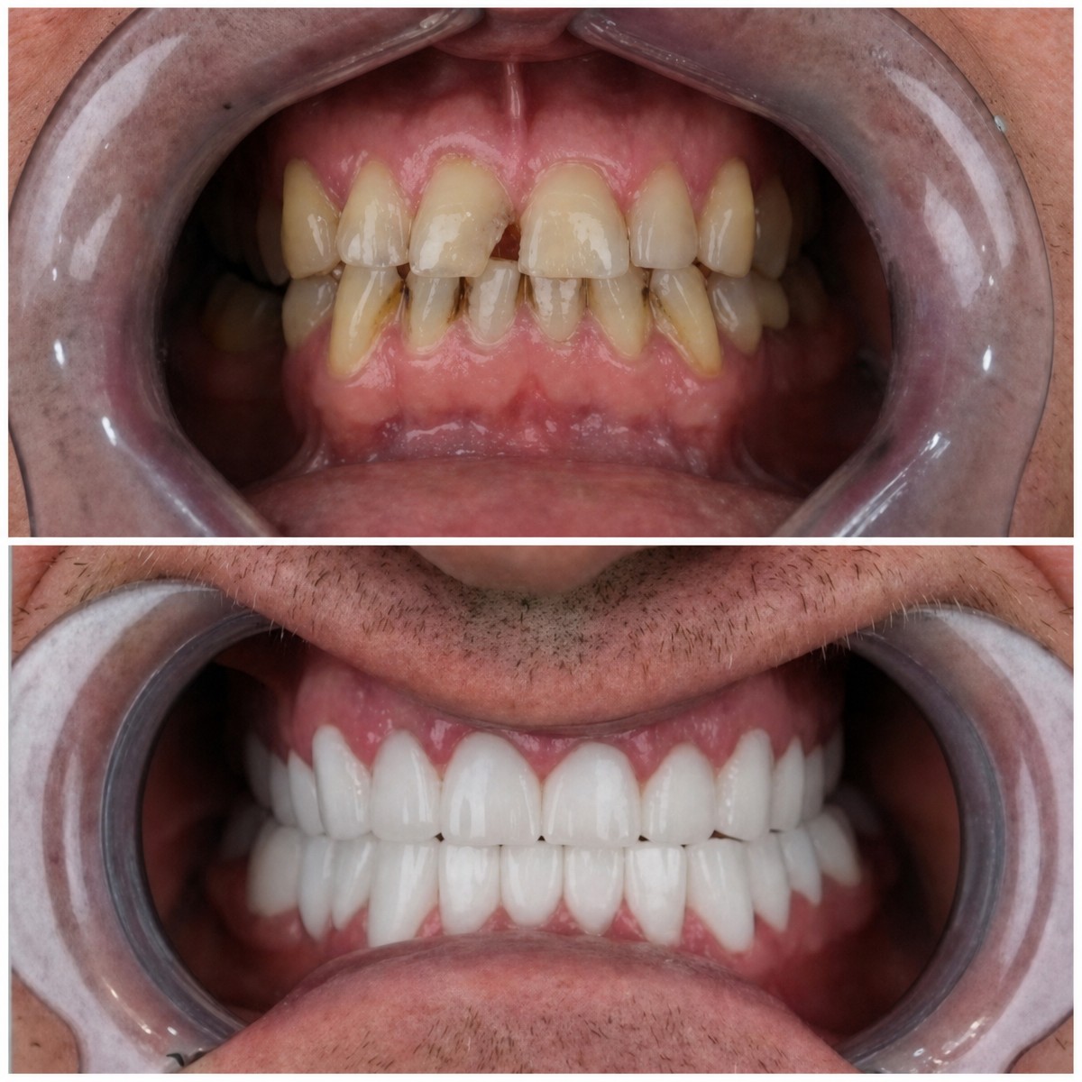 Before and after denture results at YEG Clinic – improved smile and whiter teeth