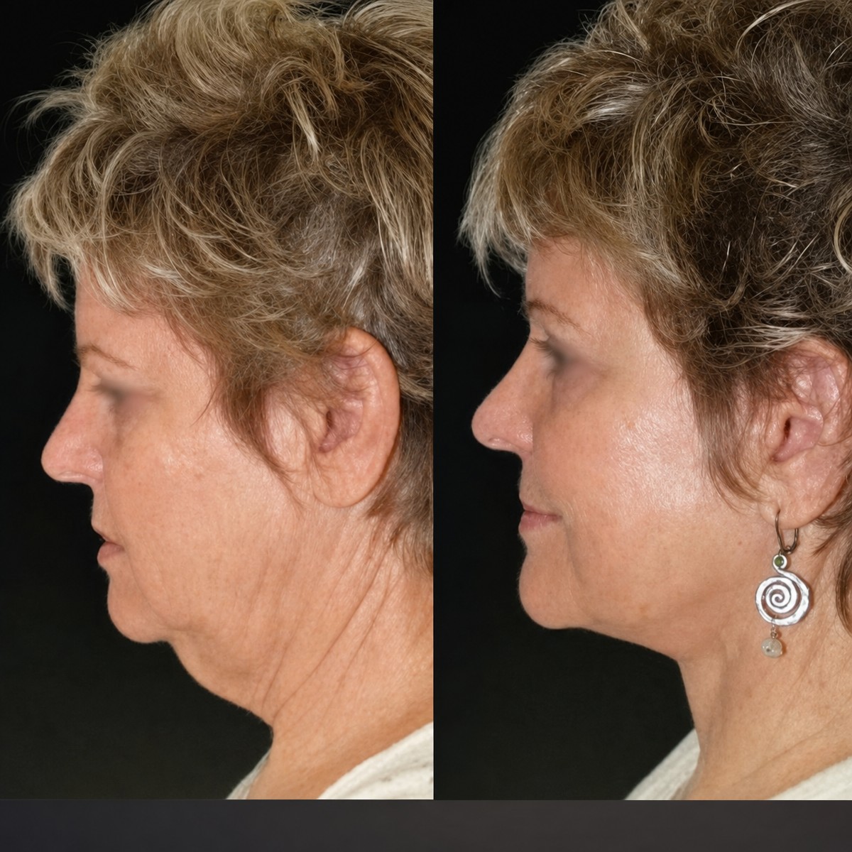 Facelift before and after results at Memorial Şişli Hospital – visible neck and jawline lift