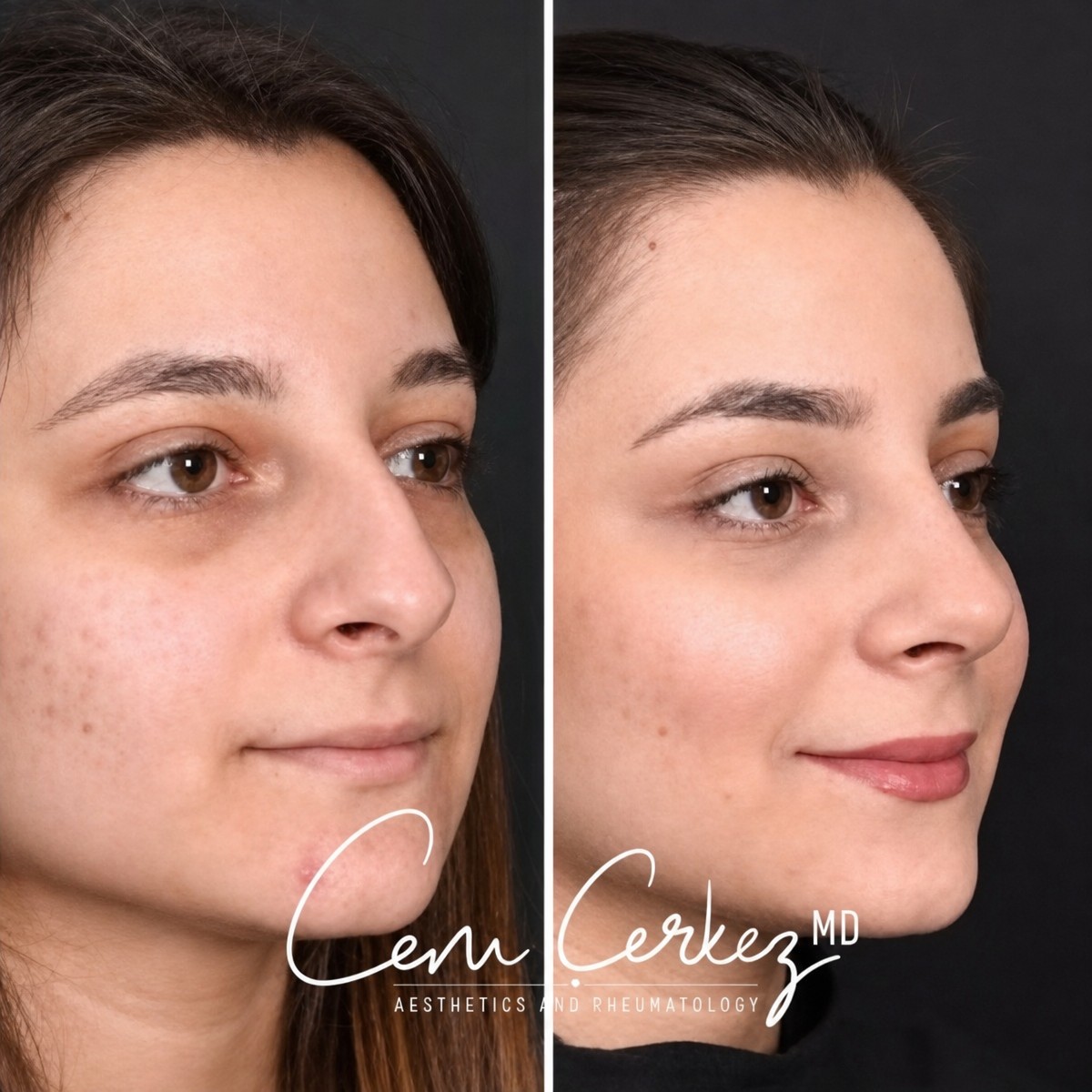 Before and after rhinoplasty results at RENOVIUM CLINIC BY CEM CERKEZ MD, nose reshaping