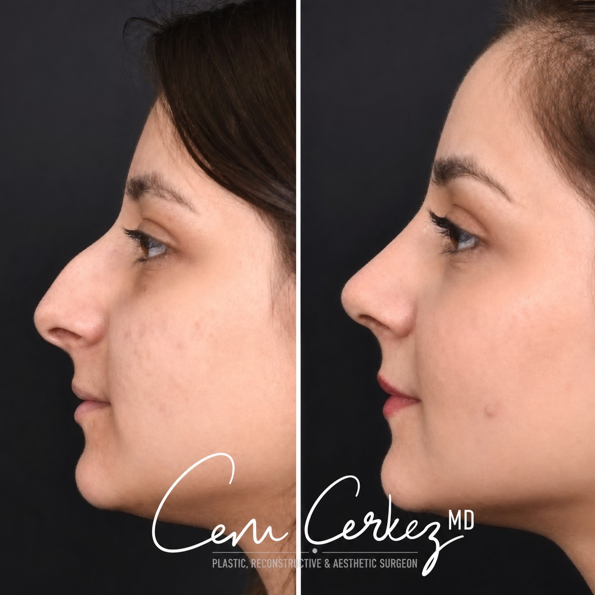 Результаты ринопластики до и после в RENOVIUM CLINIC BY CEM CERKEZ MD, улучшенная форма носа