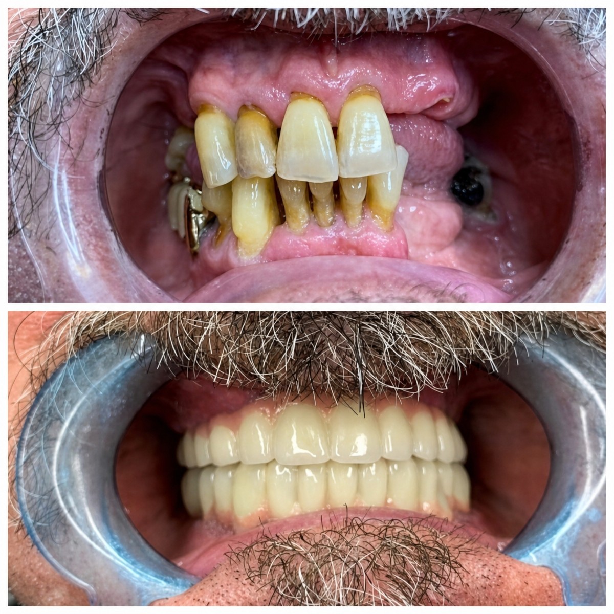 Before and after Hybrid All-on-4 implant denture results at DDS Nilza Márquez Dental Practice