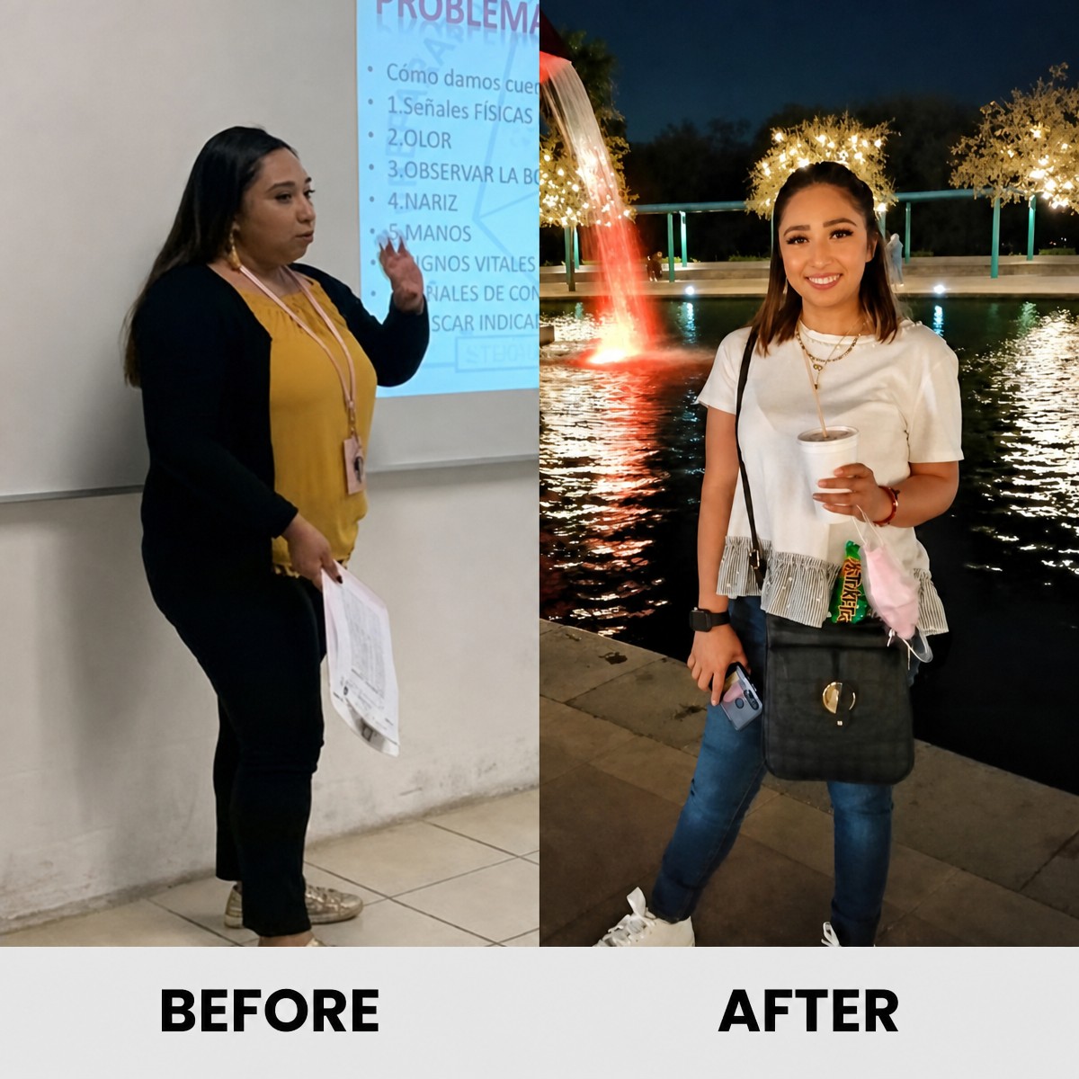 نتائج قبل وبعد تكميم المعدة في عيادة OBESITY FREE-DR. GABRIEL ROSALES
