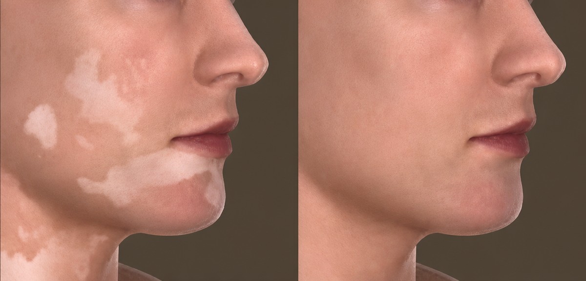 Before and after stem cell treatment for vitiligo at ID Clinic Bangkok, skin tone improvement result
