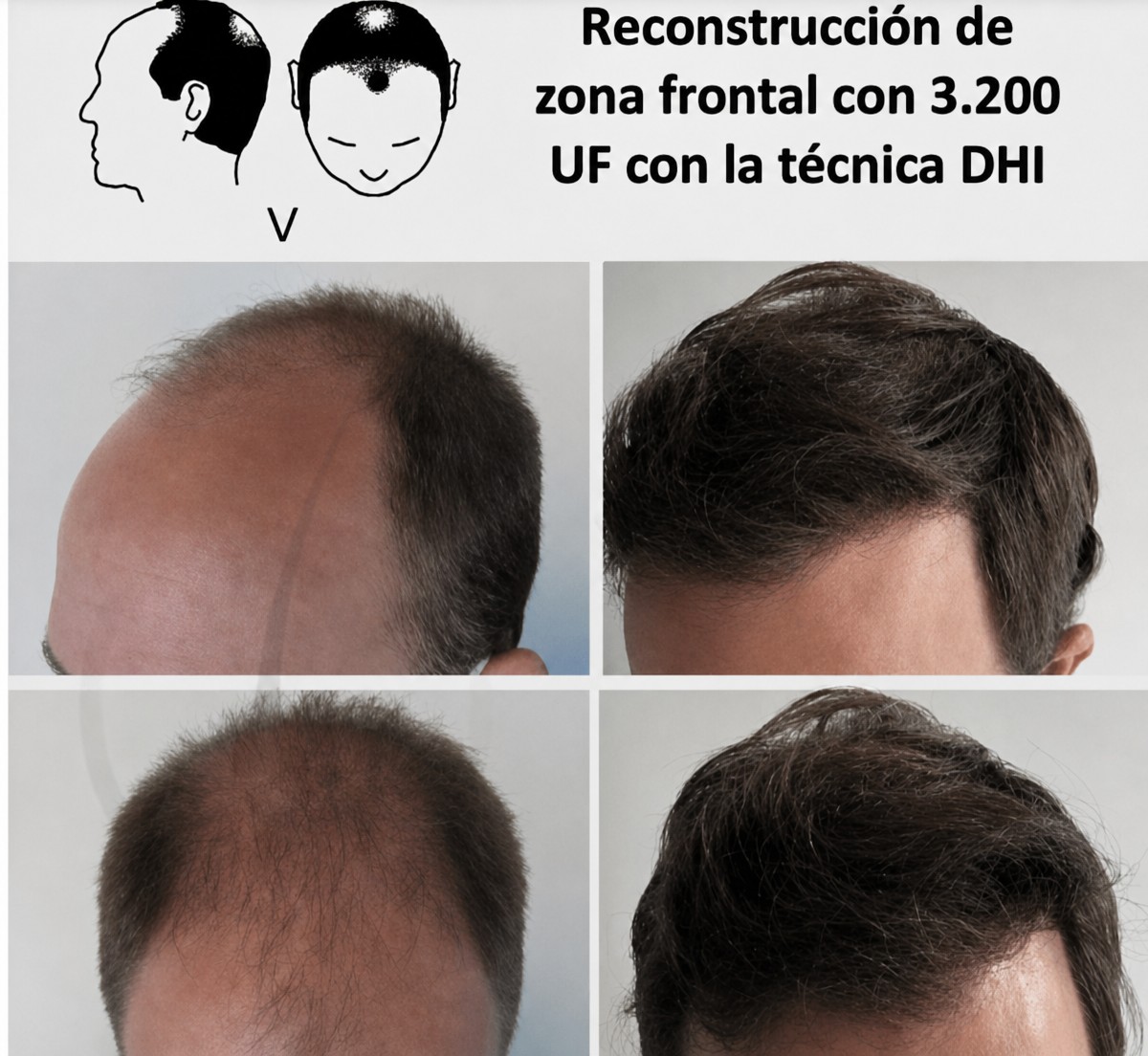 Résultats avant/après greffe de cheveux DHI au Centro Médico Teknon, ligne frontale restaurée