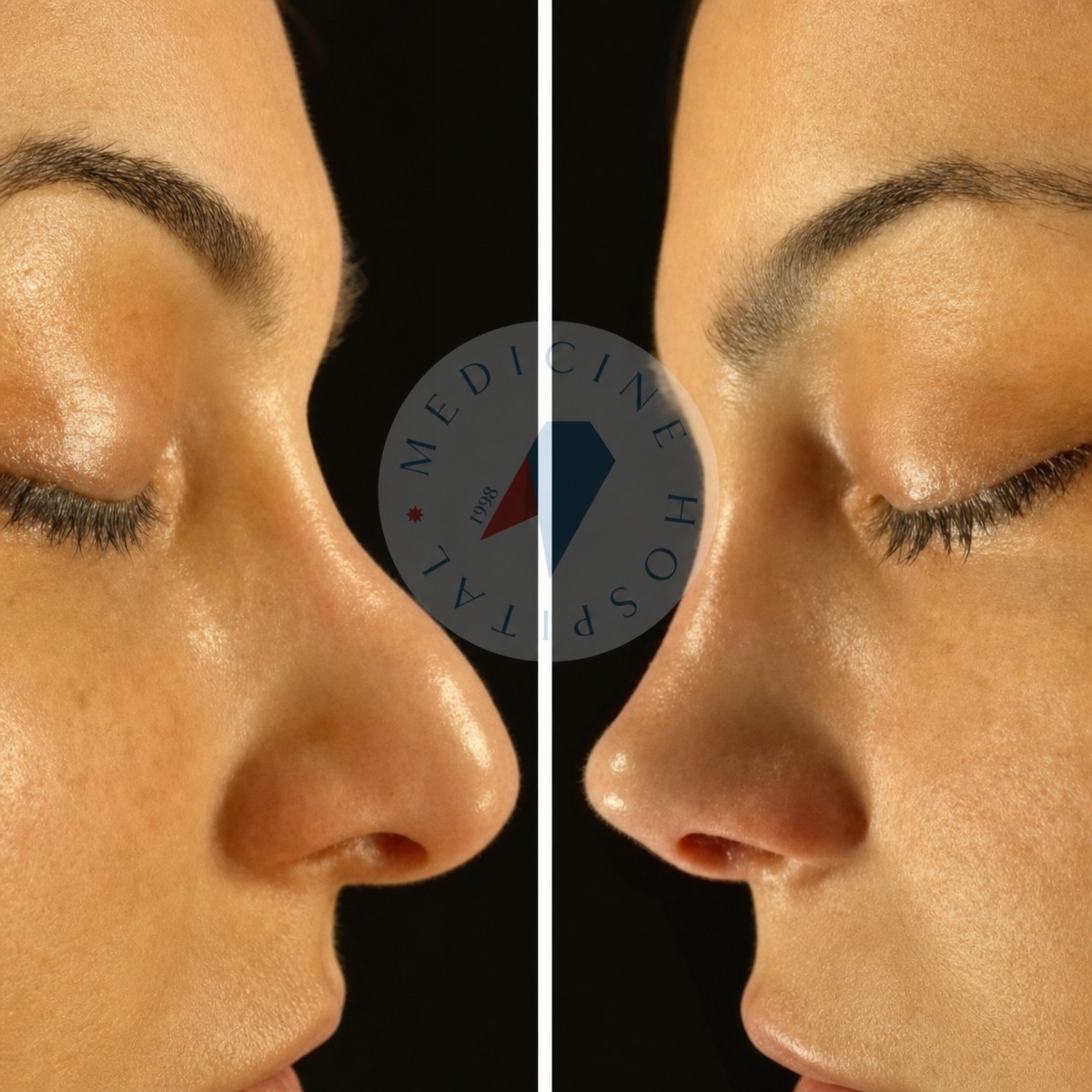 Before and after rhinoplasty results at Atlas University Hospital, nose reshaping improvement