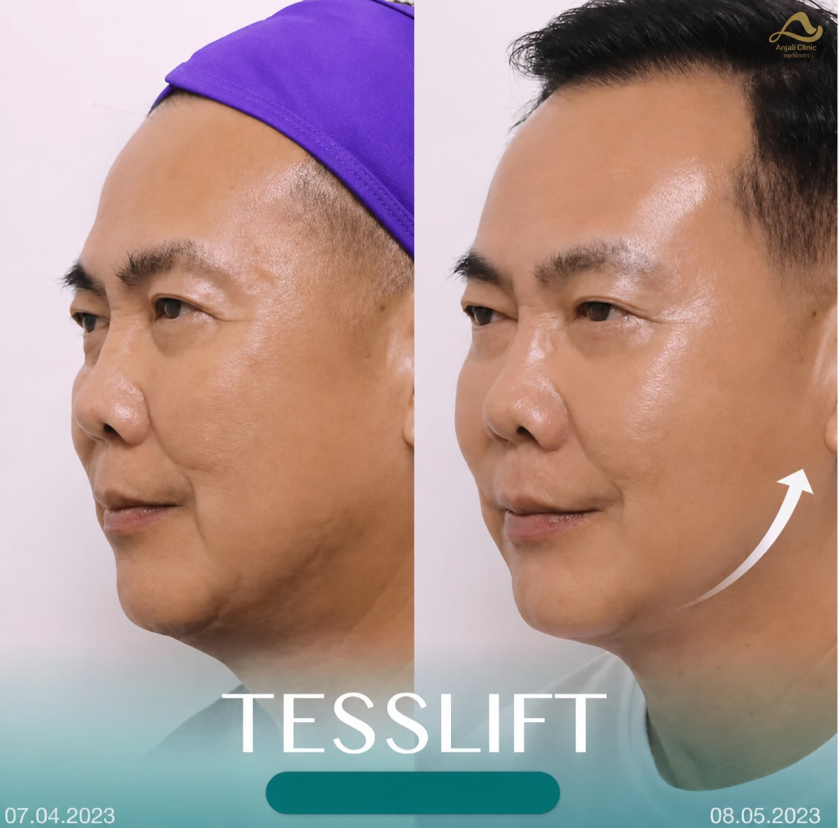 Résultats avant/après lifting non chirurgical au Anjali Clinic, effet liftant visible