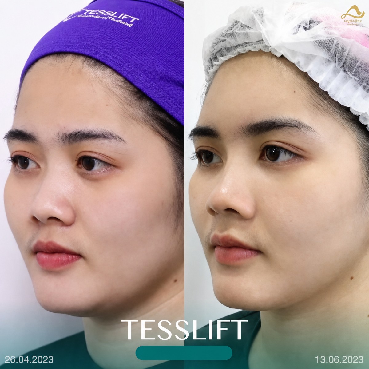 Resultados de lifting facial no quirúrgico antes y después en Anjali Clinic, contorno visible