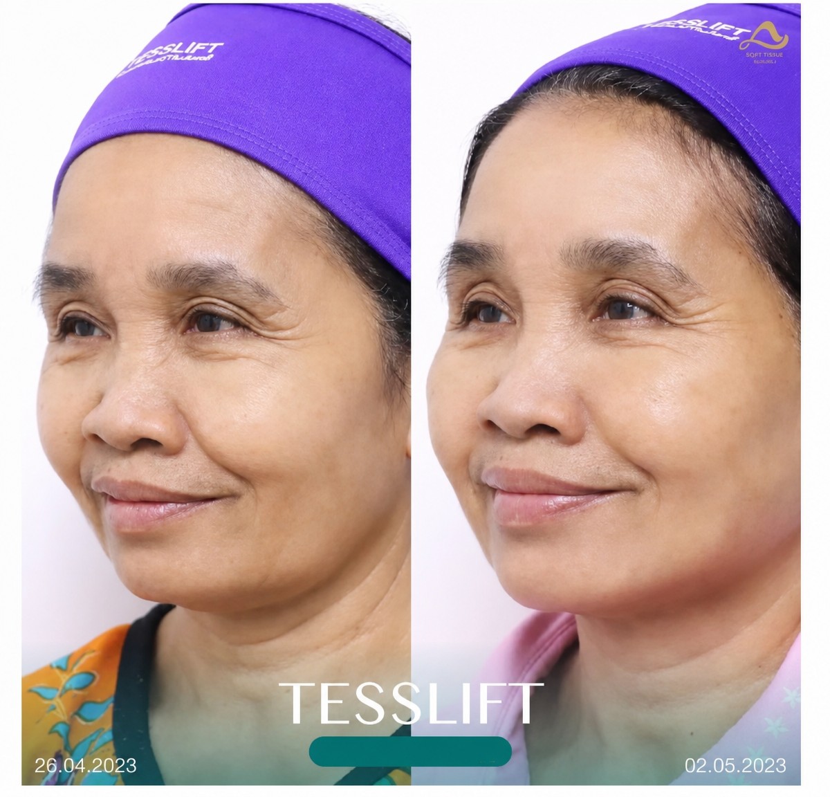 Before and after nonsurgical facelift results at Anjali Clinic – visible facial rejuvenation