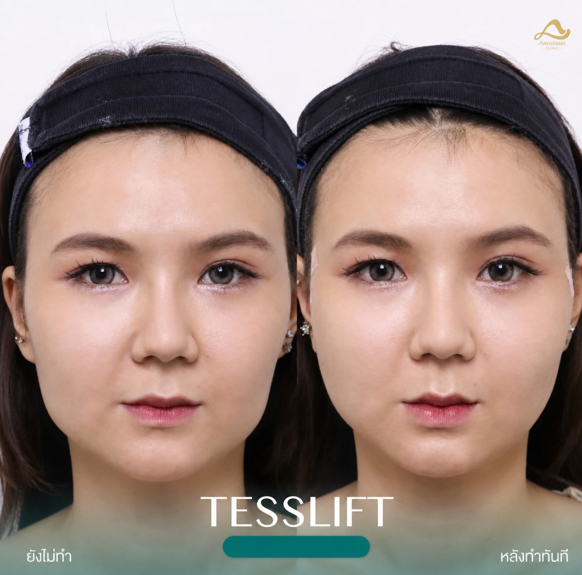 Résultats avant/après lifting facial non chirurgical à Anjali Clinic, effet liftant visible
