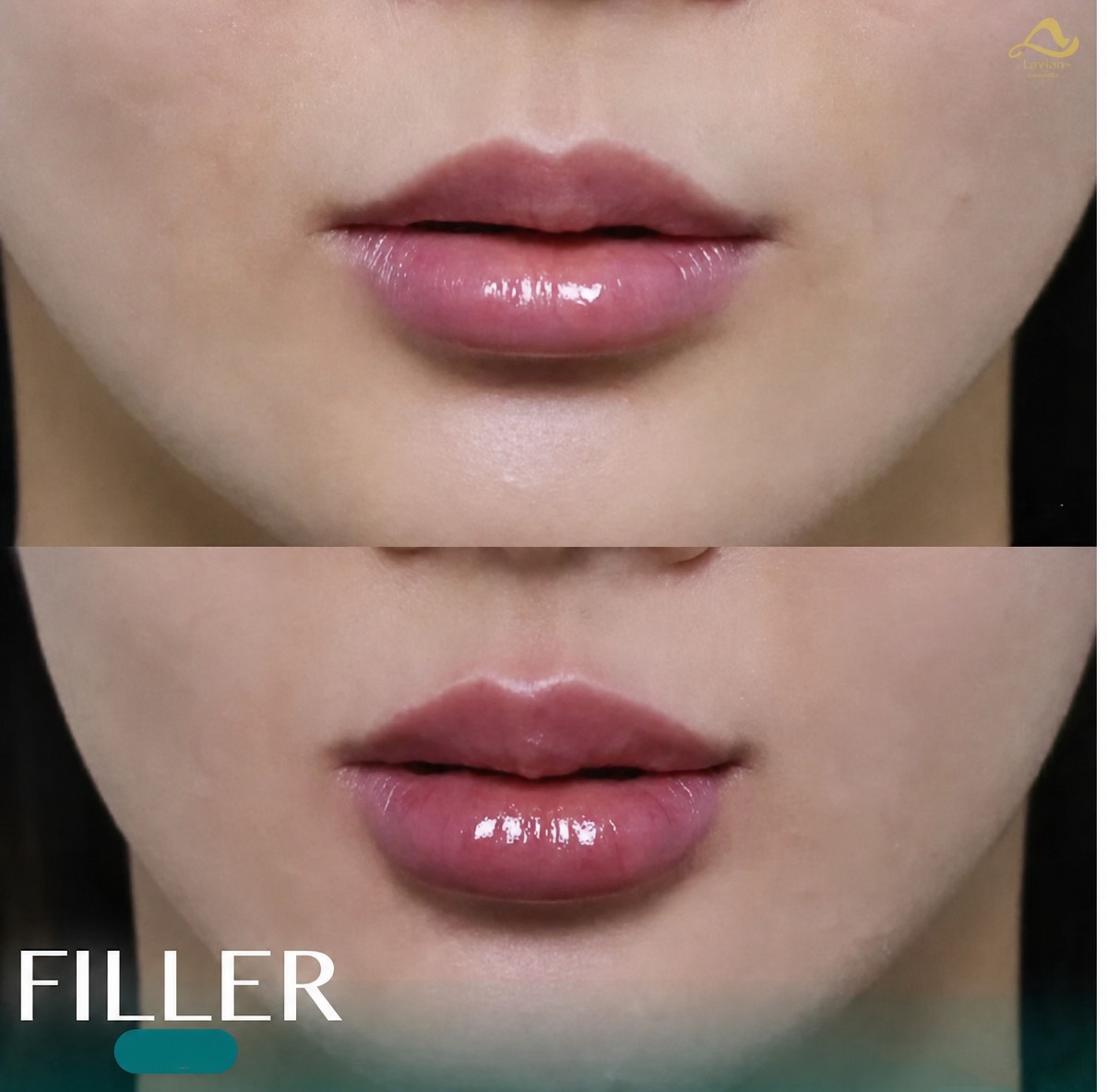 Avant et après injections de fillers lèvres à Anjali Clinic, résultat volume et contour