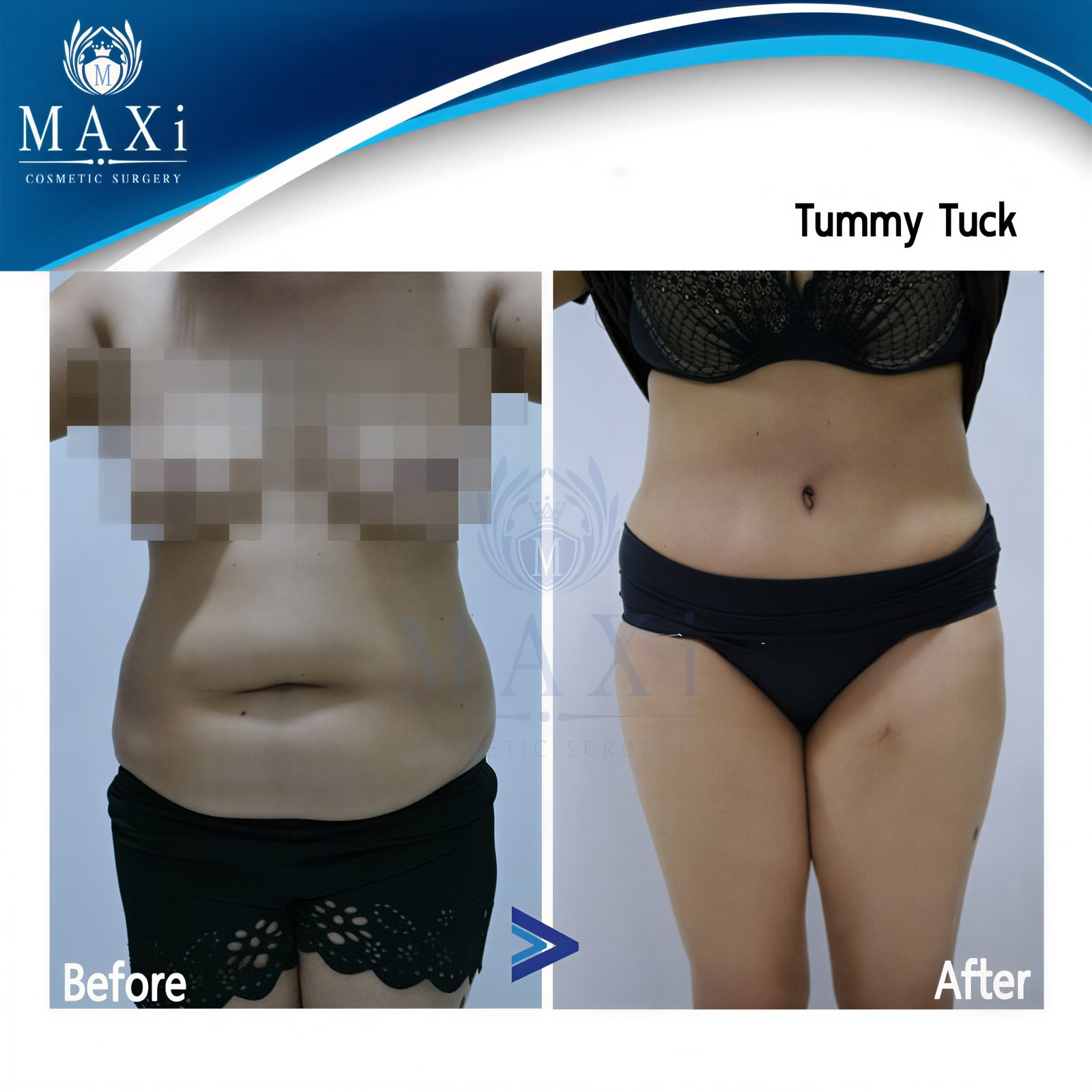 Resultados de abdominoplastia antes y después en MAXi Cosmetic Surgery – contorno abdominal visible