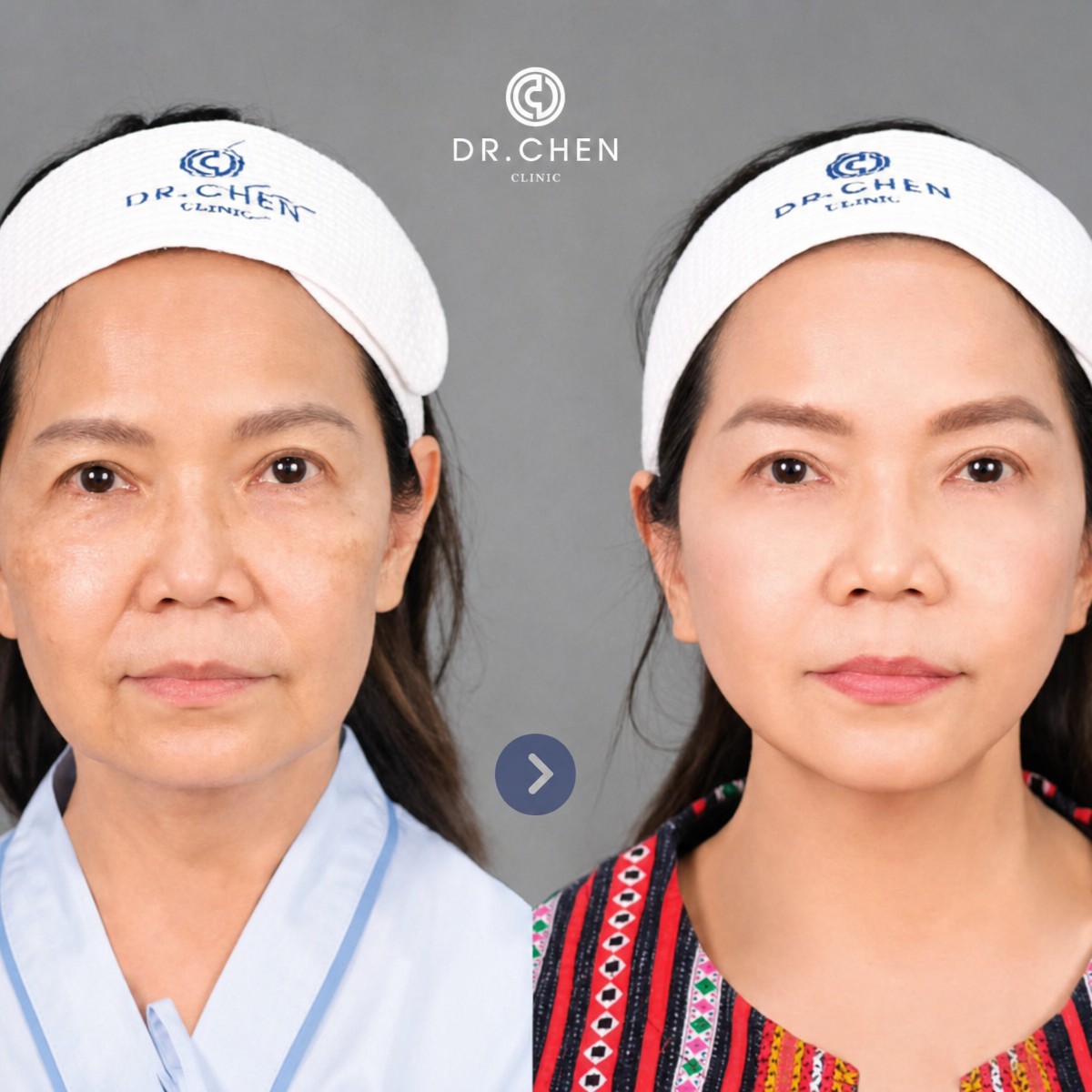 Before and after deep plane facelift result at Dr. Chen Surgery Hospital International Center