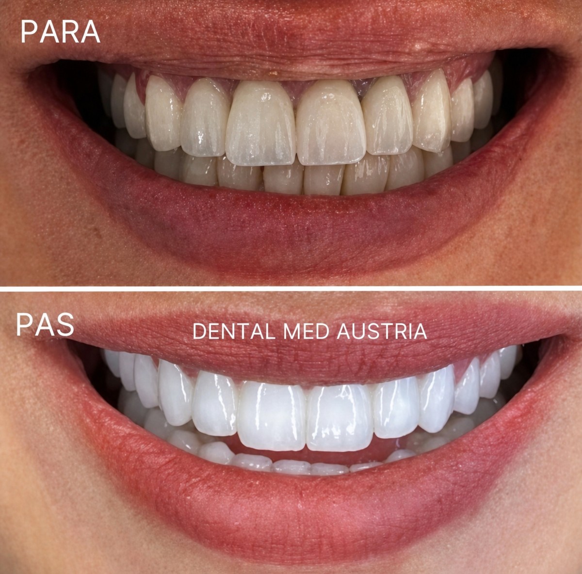 Resultados antes y después de coronas metal-cerámicas en Dental Med Austria & Elixence