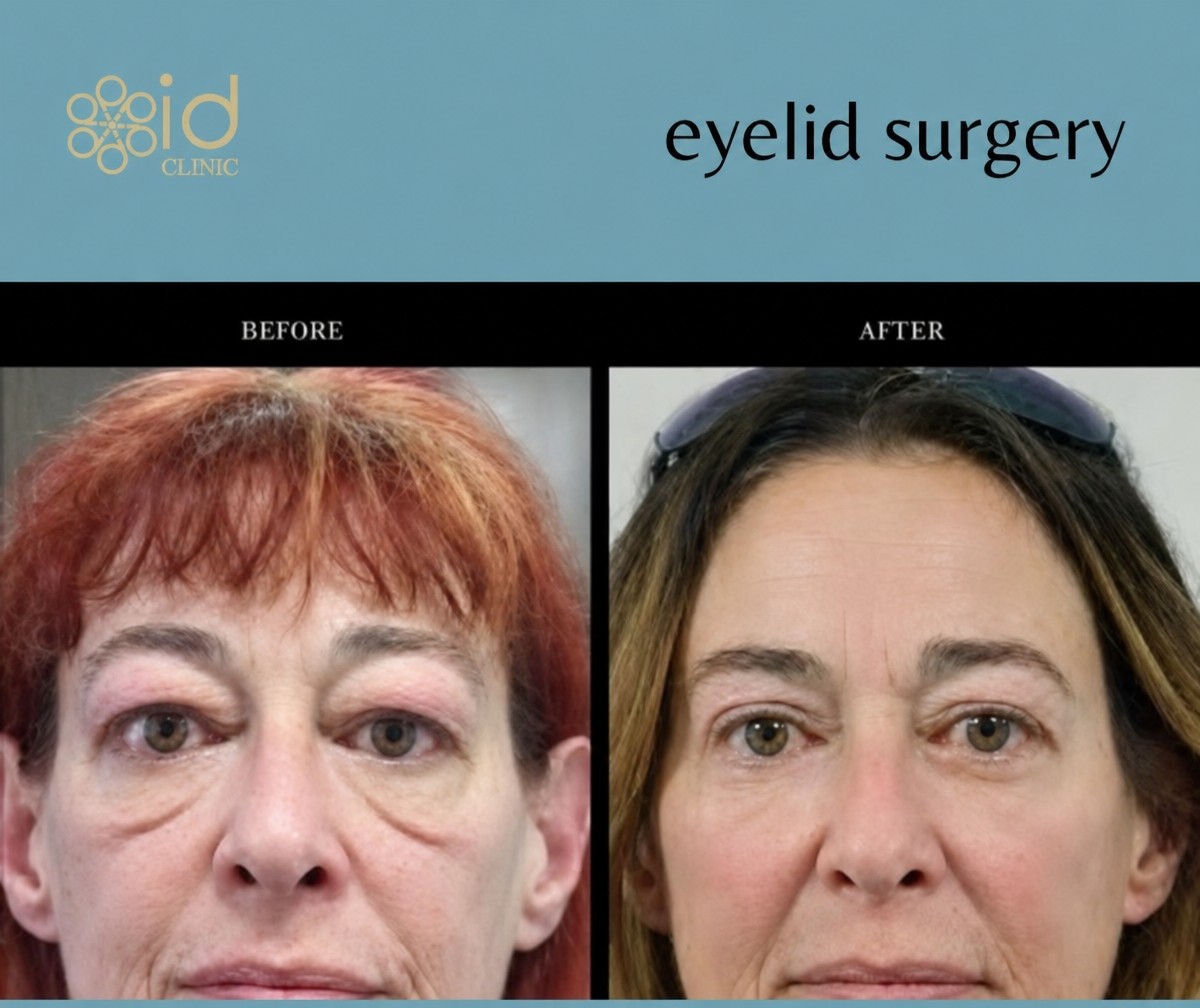 Before and after upper eyelid surgery results at ID Clinic Bangkok, improved eye appearance