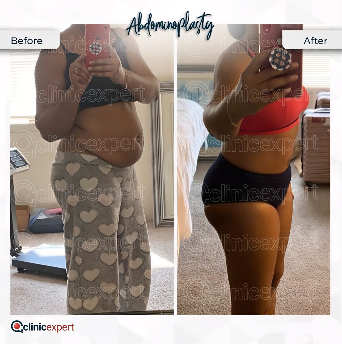 Resultados de abdominoplastia y liposucción antes y después en CE International Hospital
