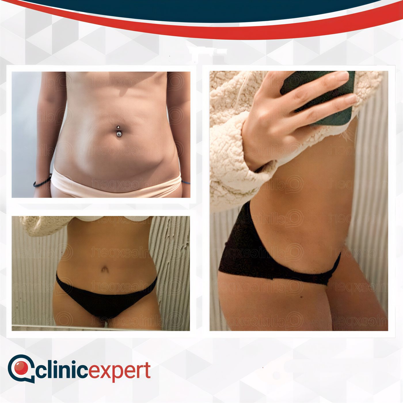 Resultados de abdominoplastia y liposucción antes y después en CE International Hospital, abdomen plano