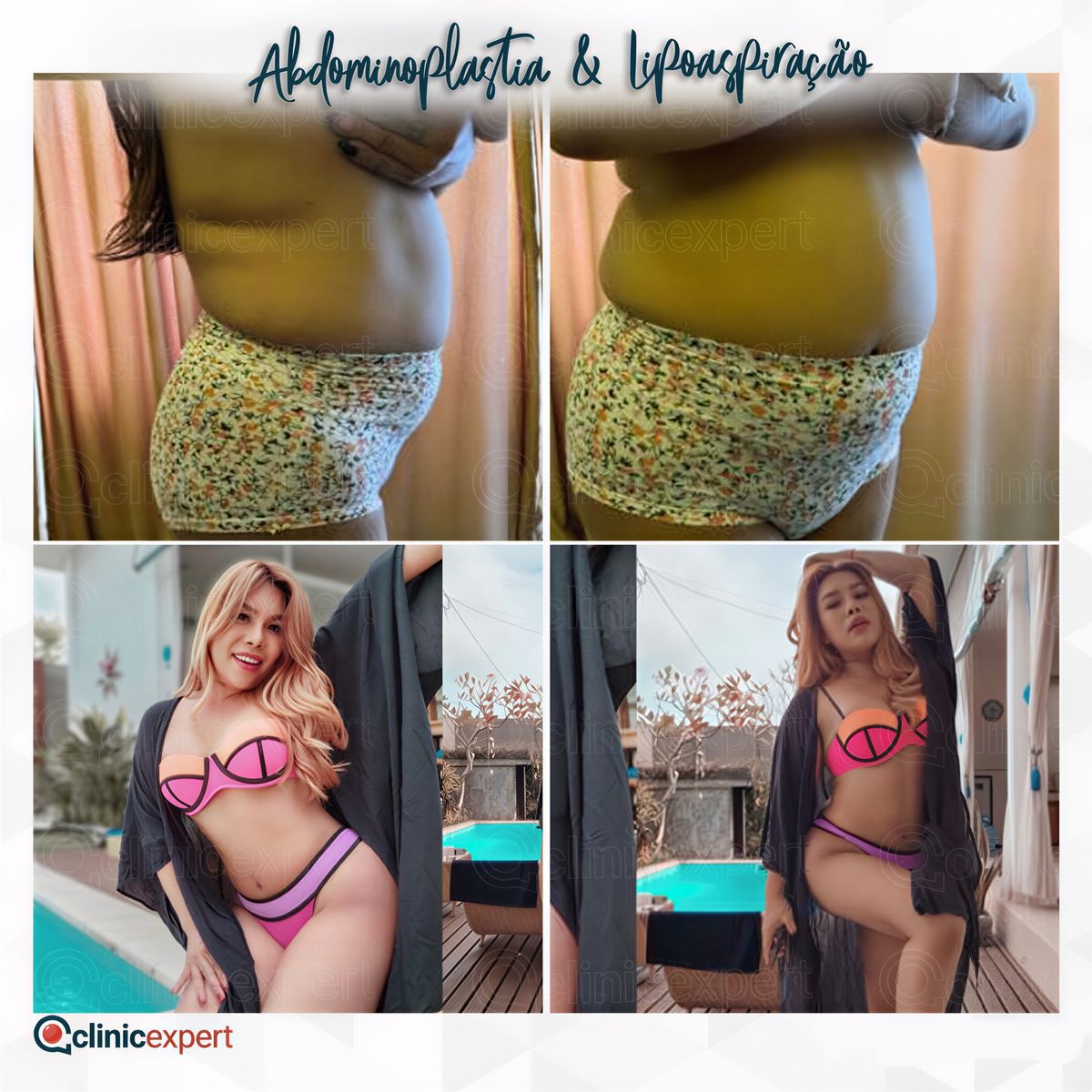 Resultados antes y después de abdominoplastia y liposucción en CE International Hospital, contorno corporal