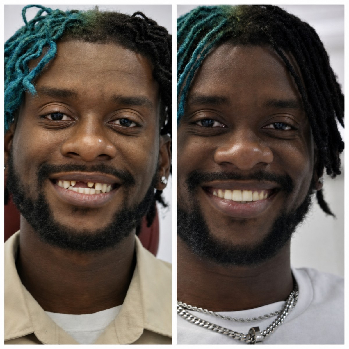 Before and after zirconia crown results at DentaPoint Dental Clinics, improved smile aesthetics