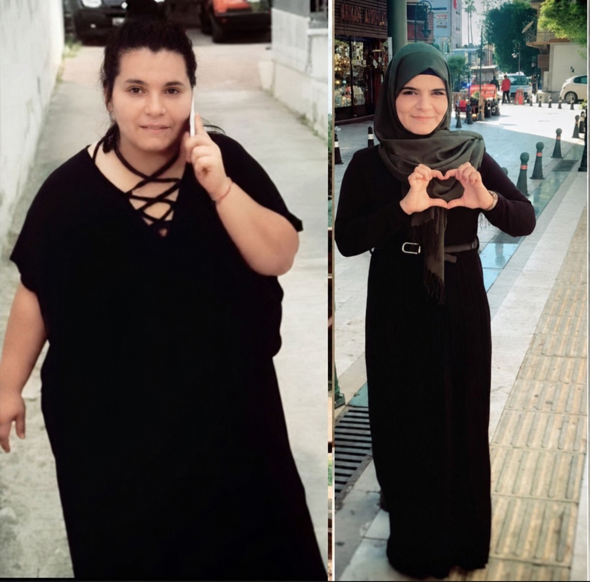 نتائج قبل وبعد بالون المعدة في عيادة Prof. Dr. Burhan Mayir Scarless Sleeve