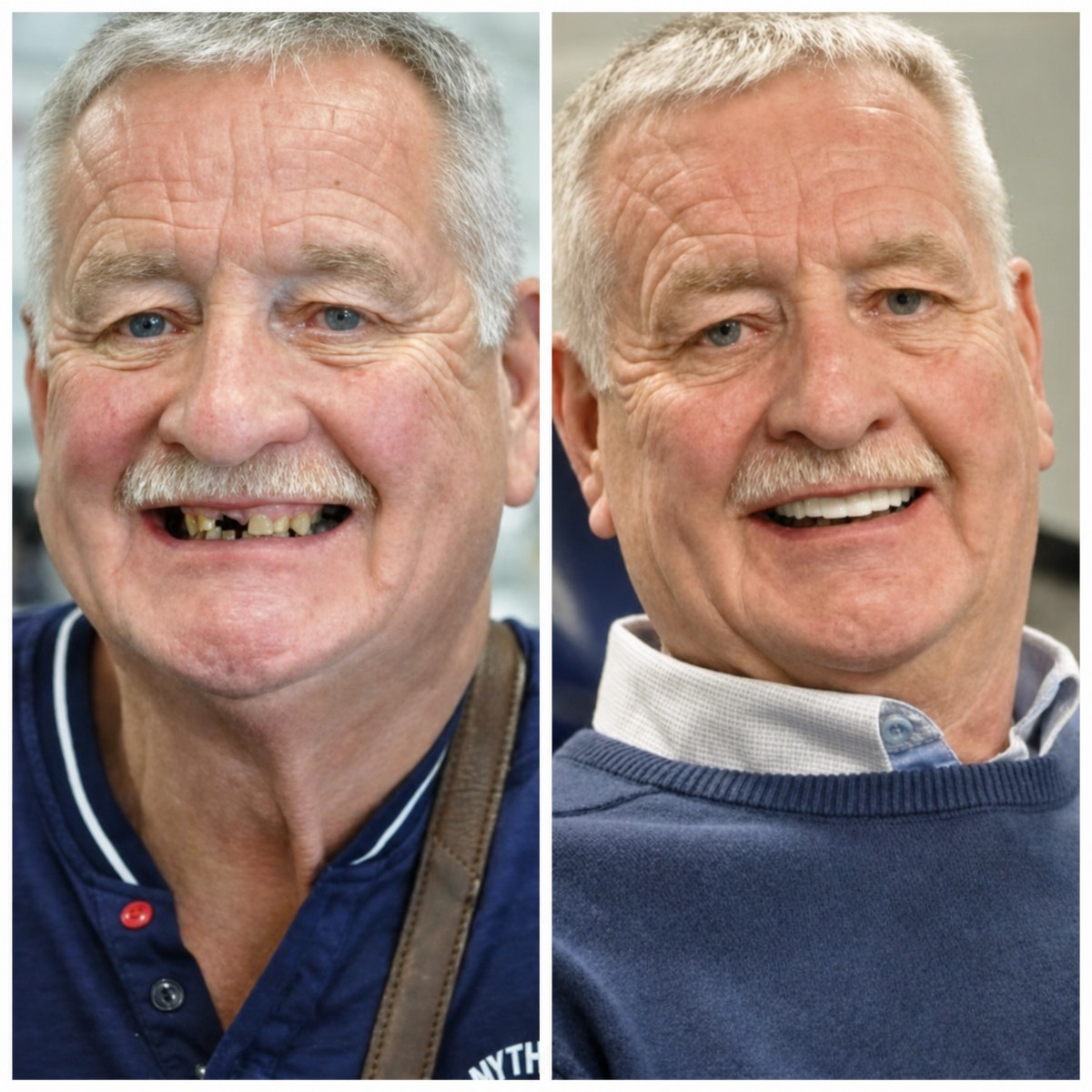 Результат до та після імплантації All-on-4 у DentaPoint Dental Clinics, відновлення усмішки