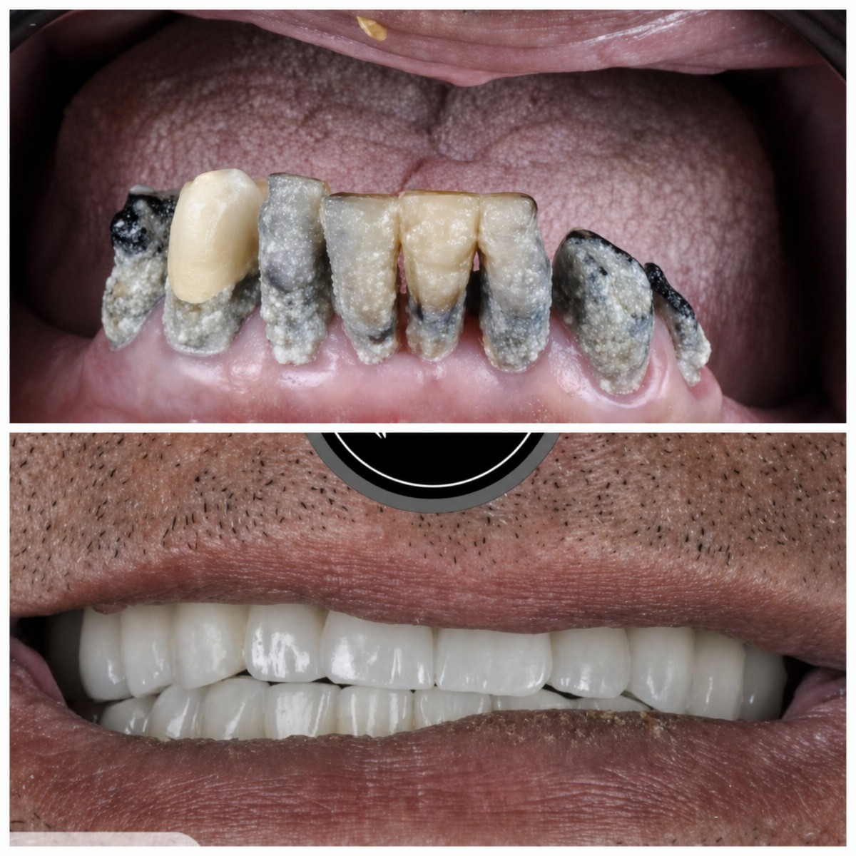 Результат до и после имплантации All-on-4 в DentaPoint Dental Clinics, восстановление улыбки