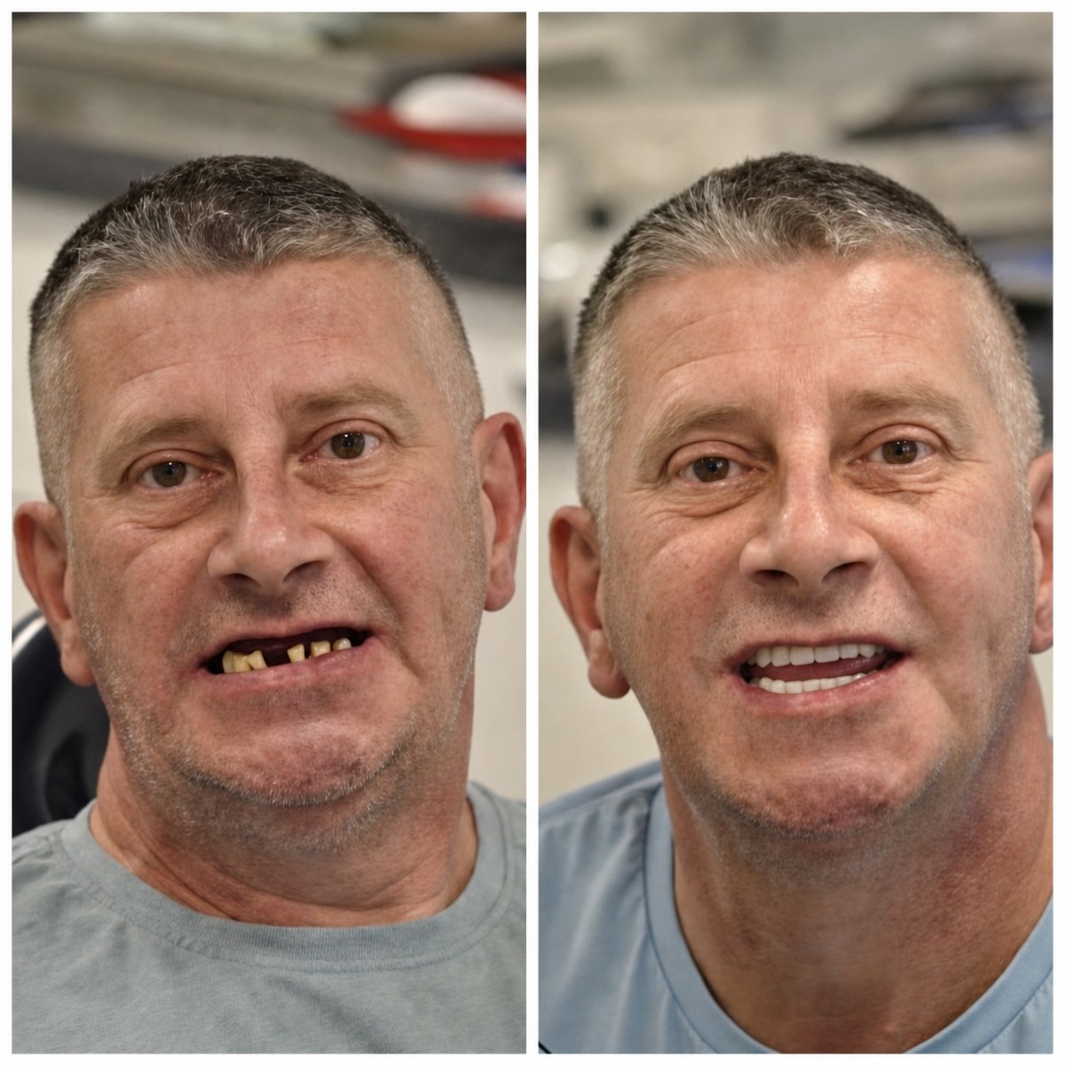 نتيجة قبل وبعد زراعة الأسنان All-on-4 في DentaPoint Dental Clinics، استعادة الابتسامة