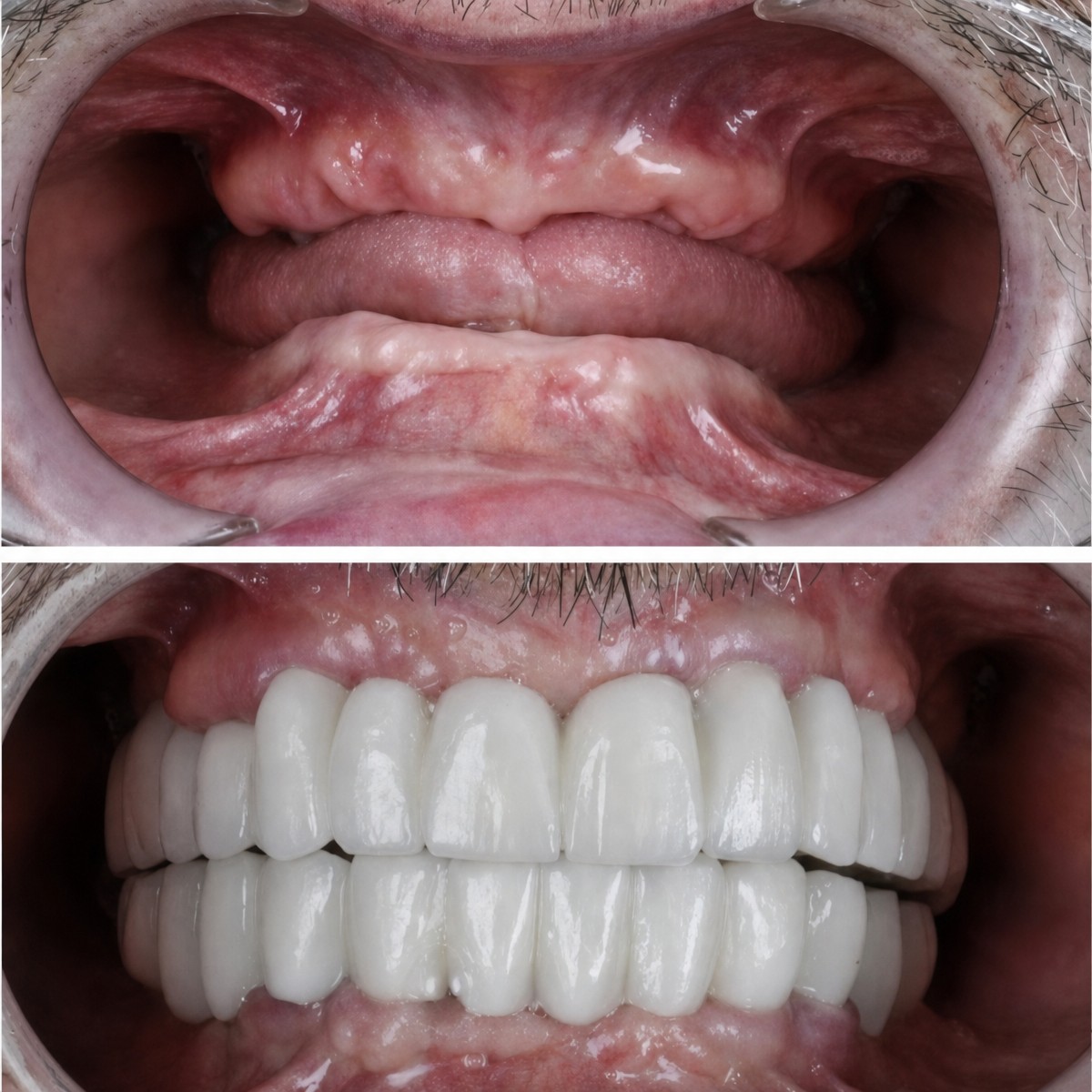 Before and after All-on-4 dental implants result at DentaPoint Dental Clinics, full smile restoration