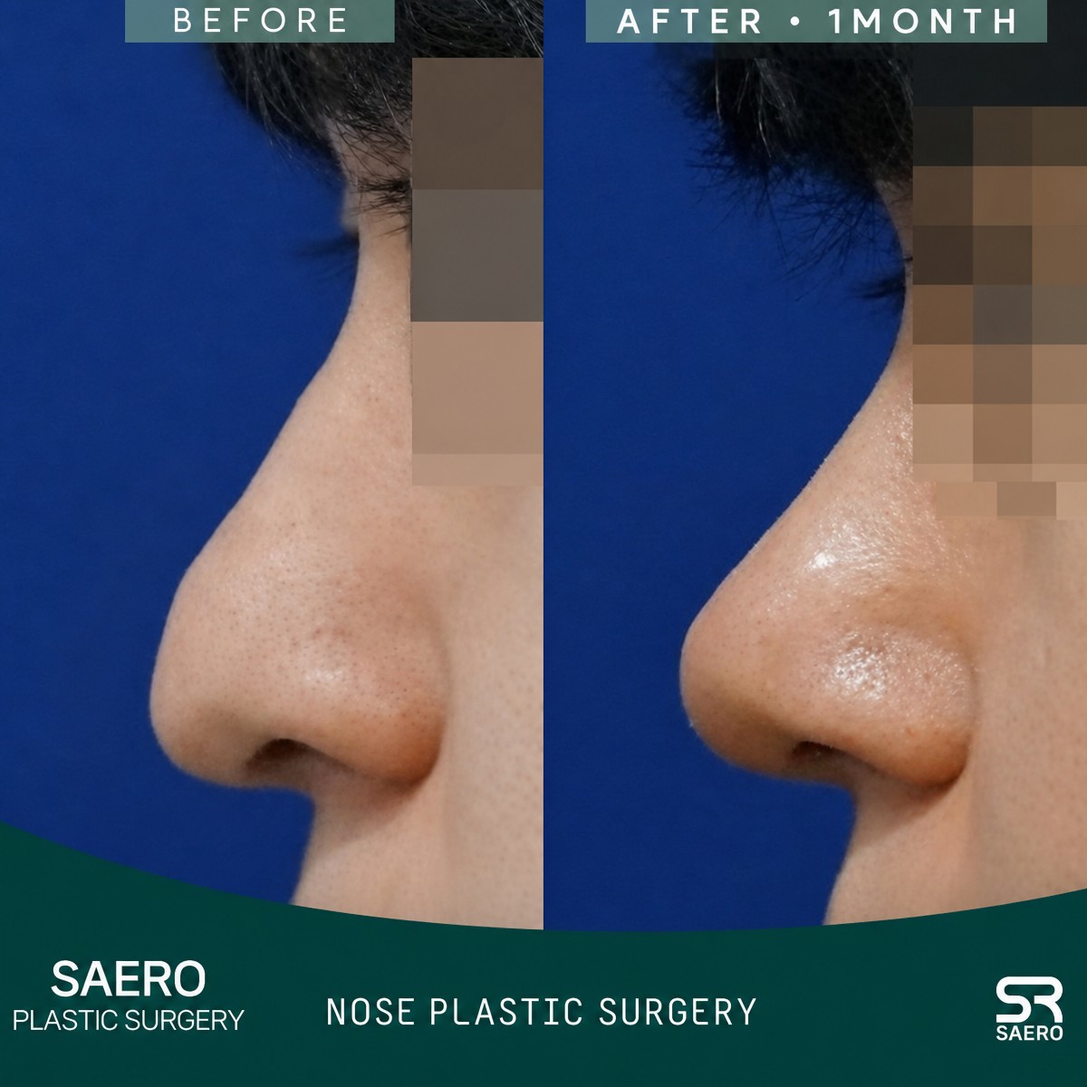 Before and after revision rhinoplasty result at SAERO Plastic Surgery, improved nose contour