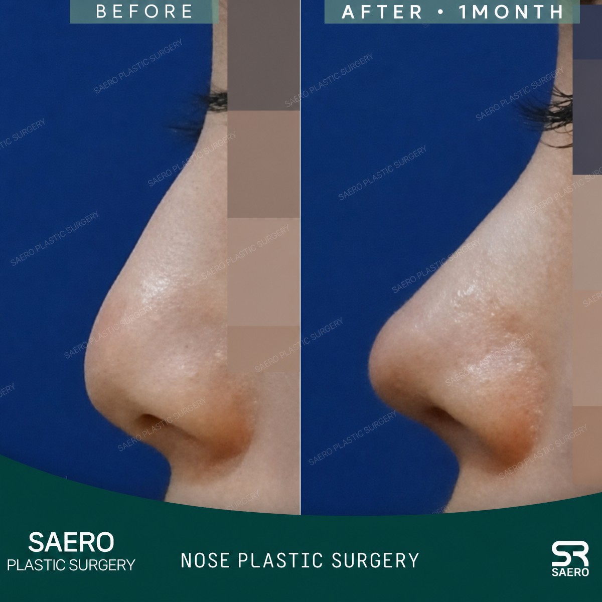 Before and after revision rhinoplasty result at SAERO Plastic Surgery, improved nose profile