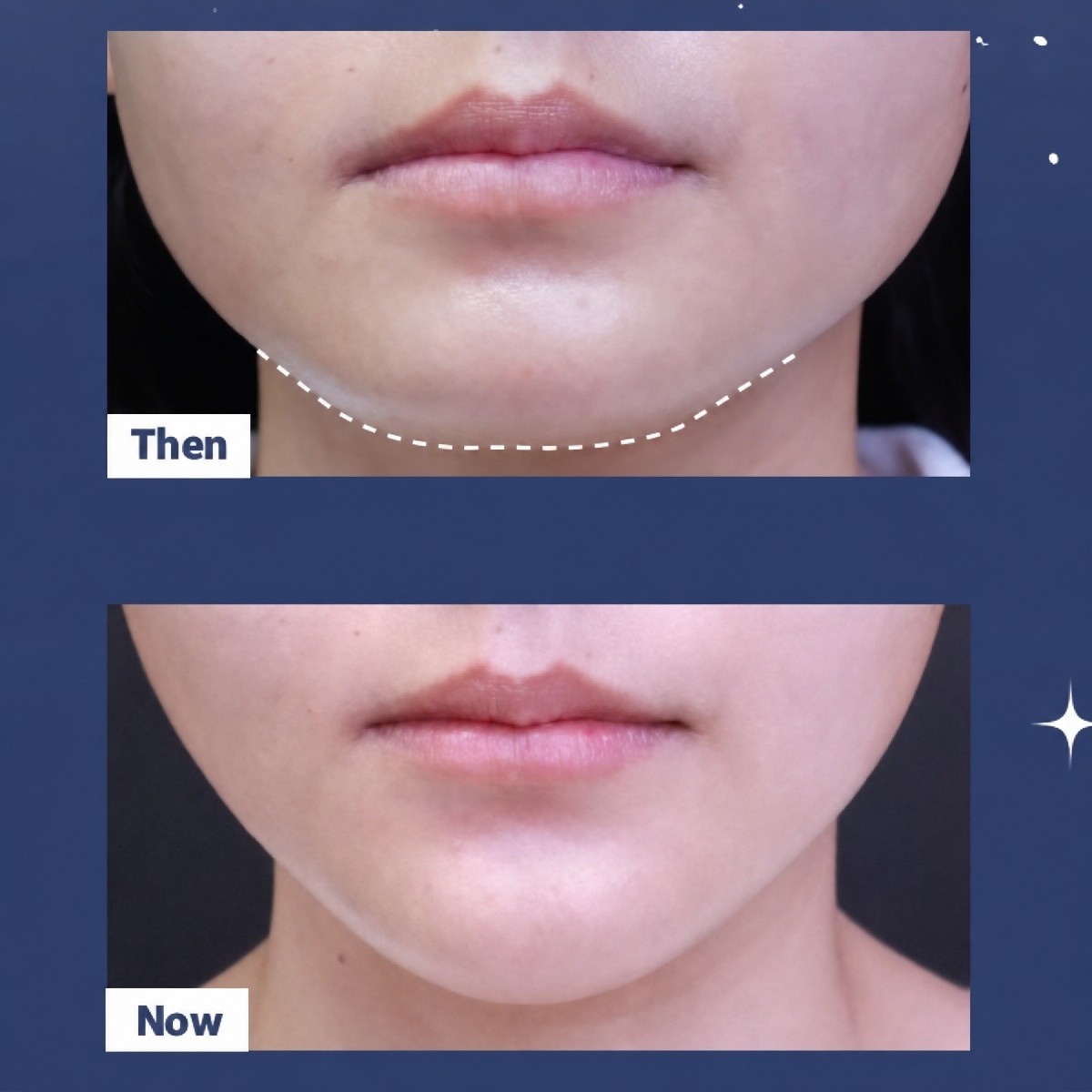 Résultats avant/après implant du menton à Asia Cosmetic Hospital, contour amélioré visible